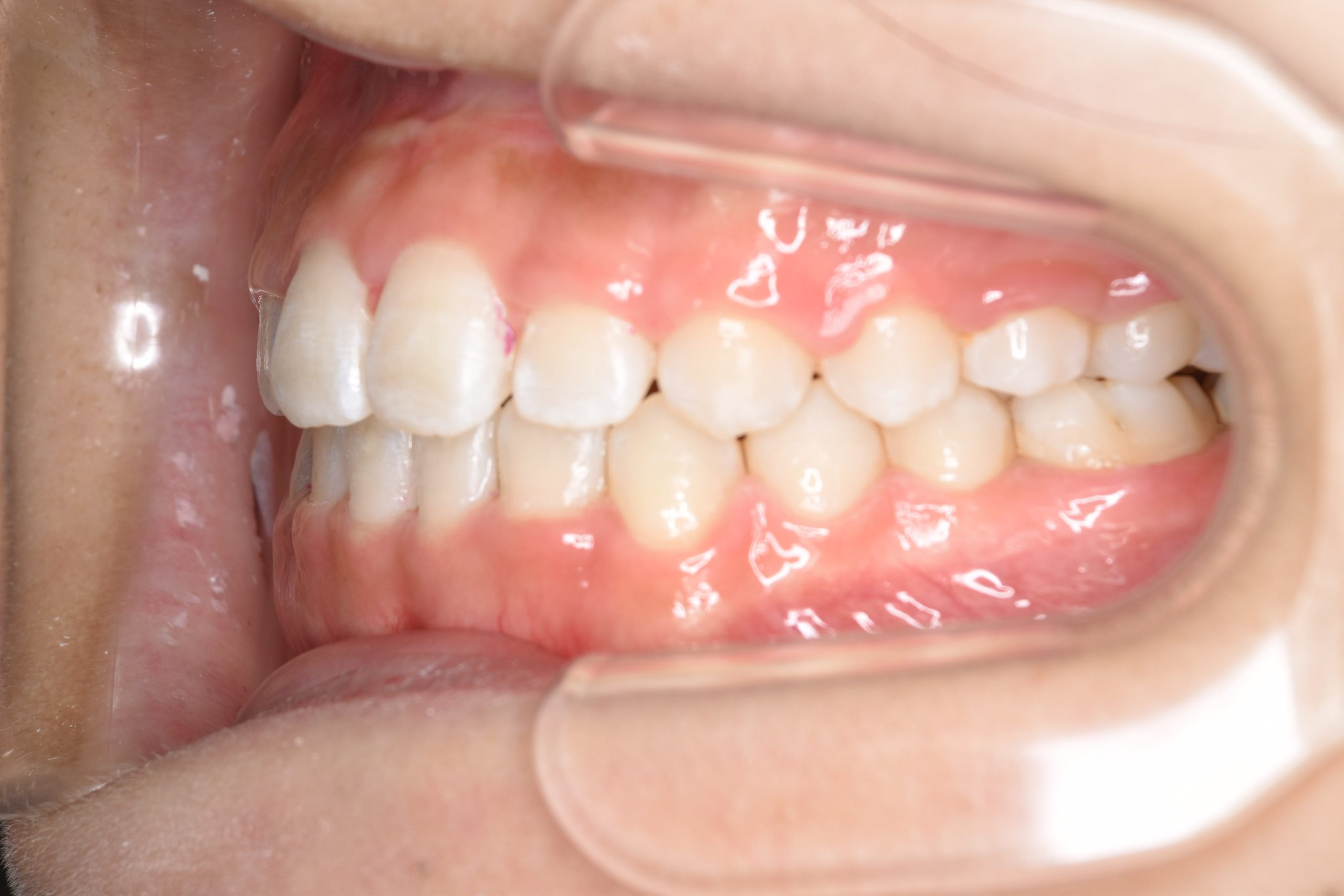 全顎ワイヤー矯正　症例_148