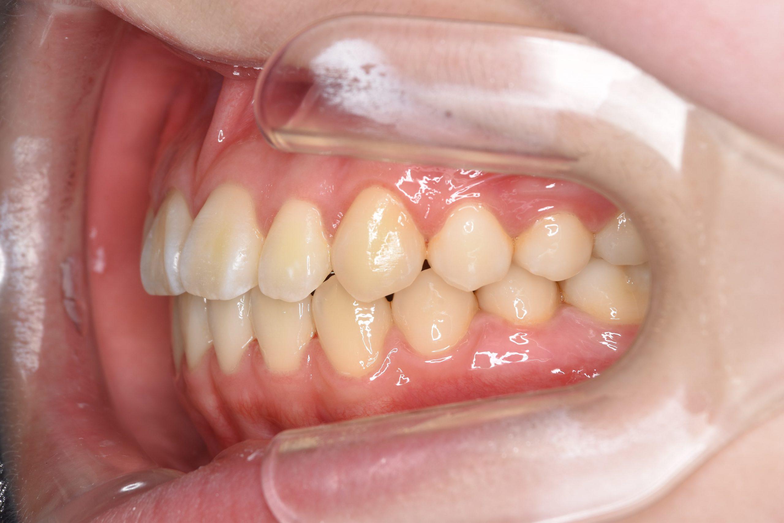 全顎ワイヤー矯正　症例_154