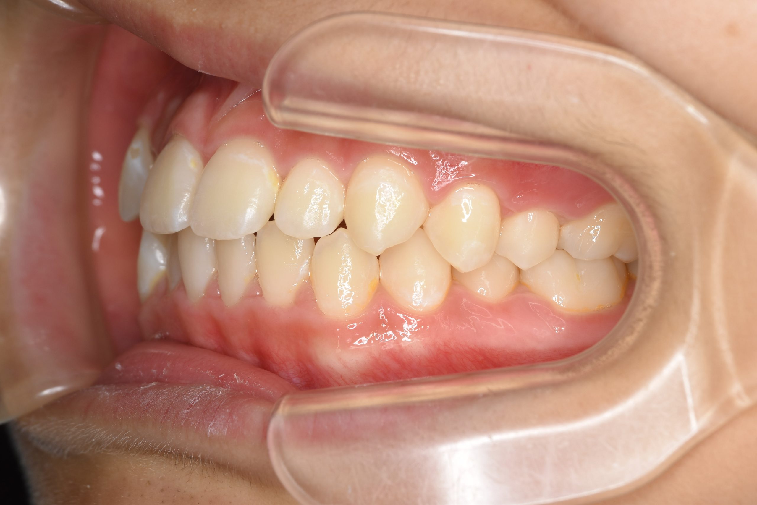 全顎ワイヤー矯正　症例_169