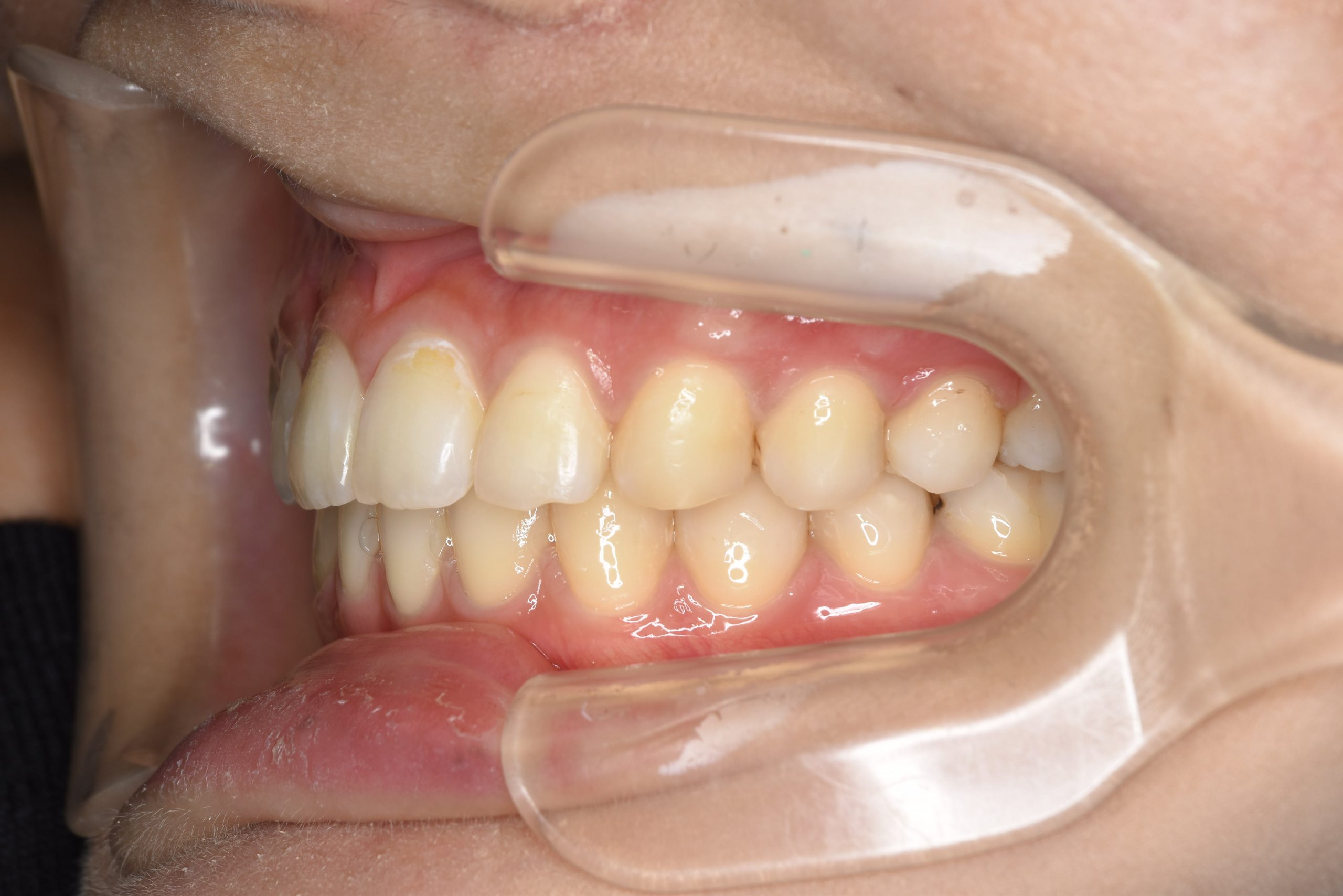 全顎ワイヤー矯正　症例_182