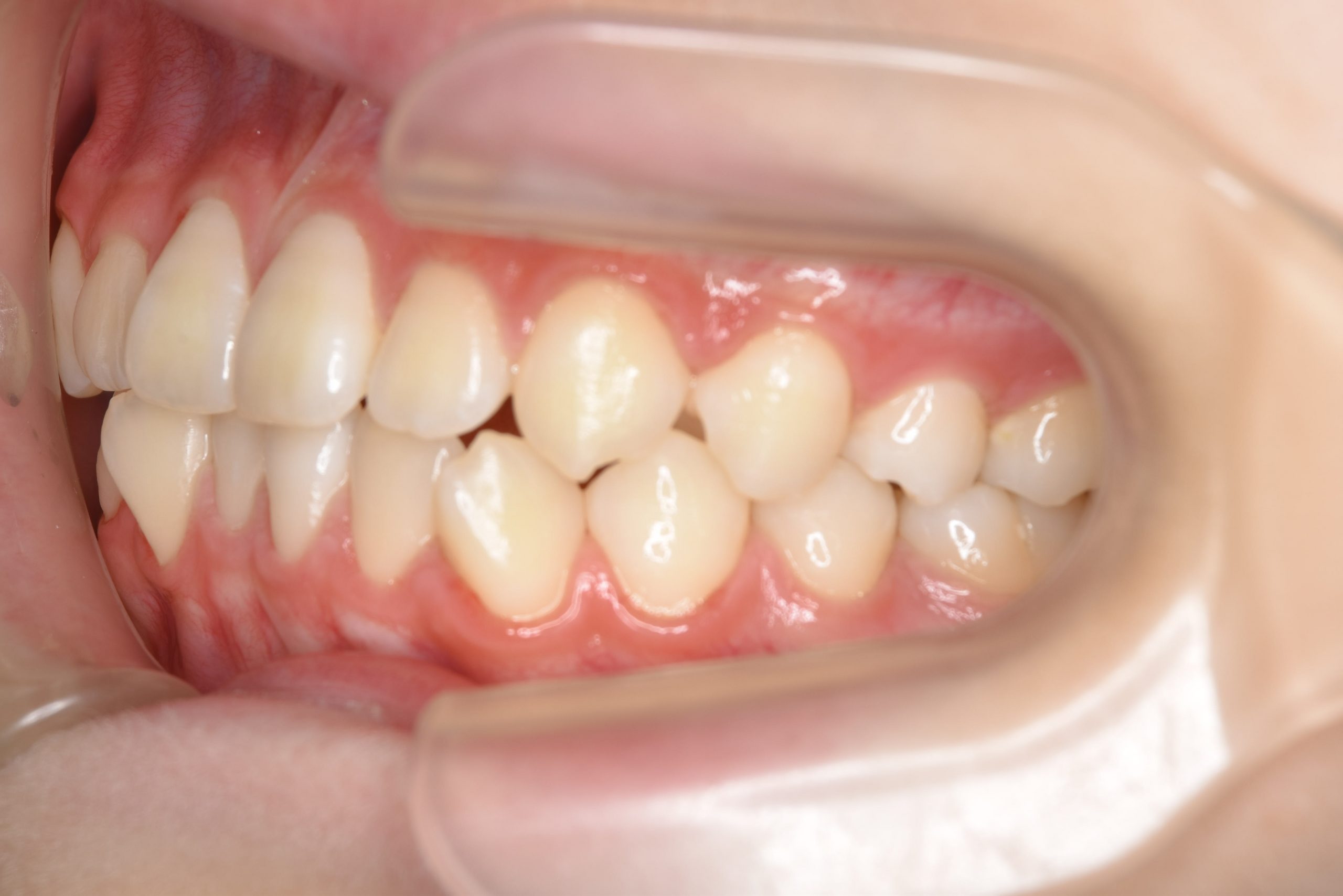 全顎ワイヤー矯正　症例_68