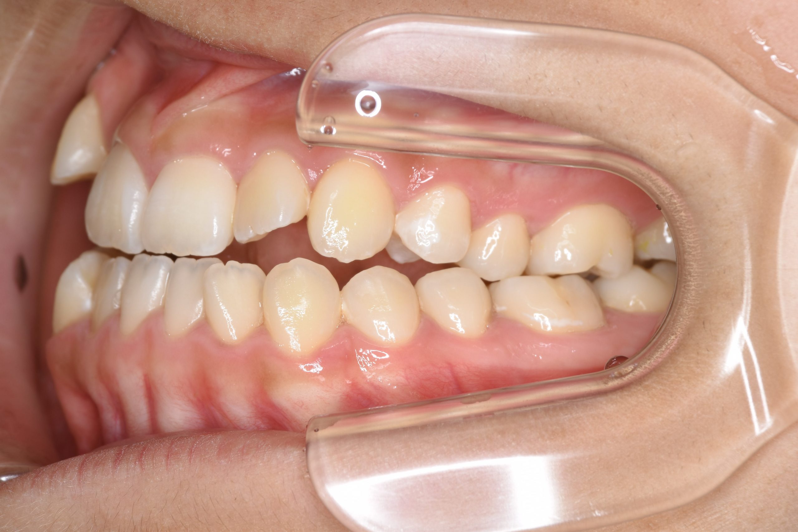 全顎ワイヤー矯正　症例_29