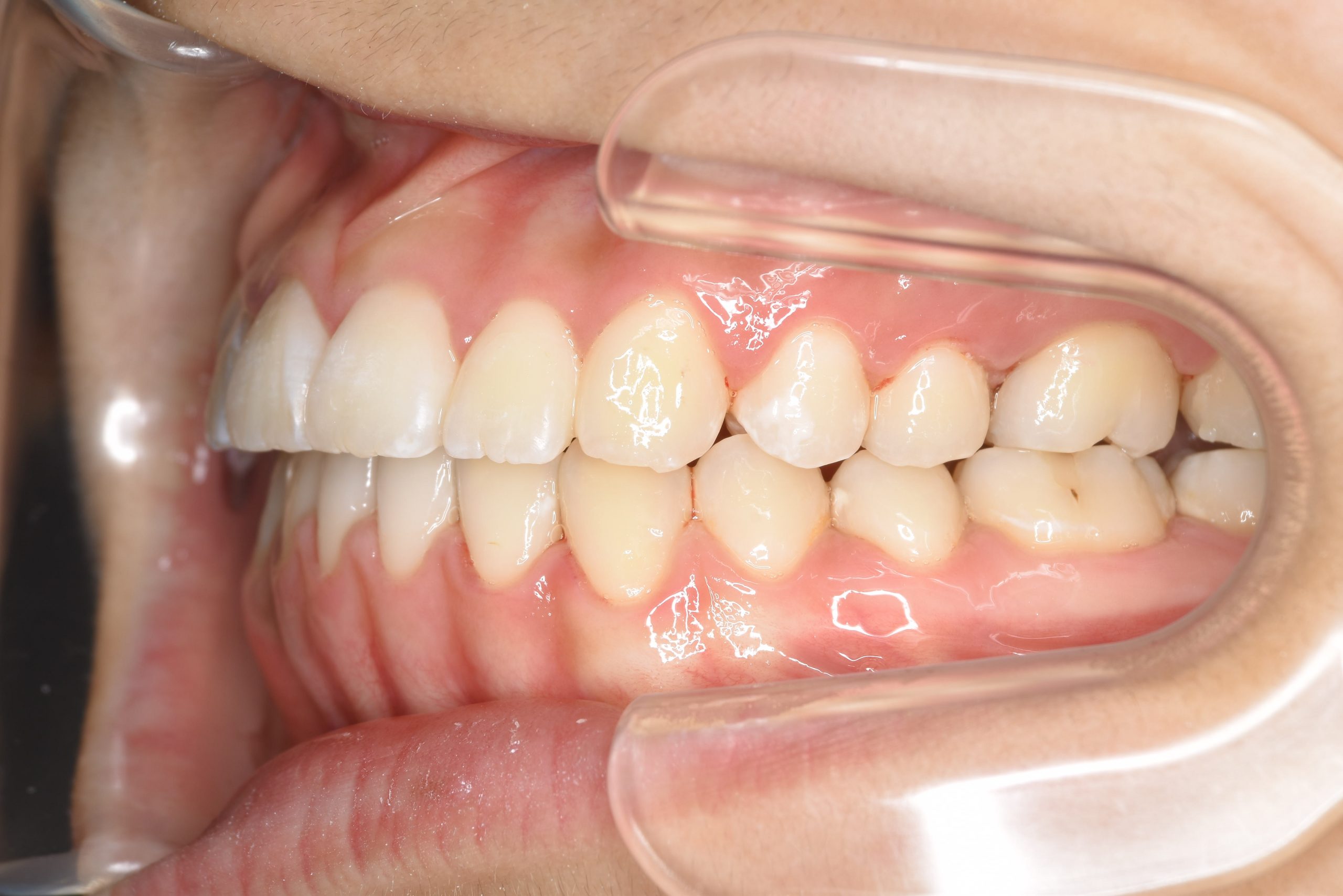 全顎ワイヤー矯正　症例_29