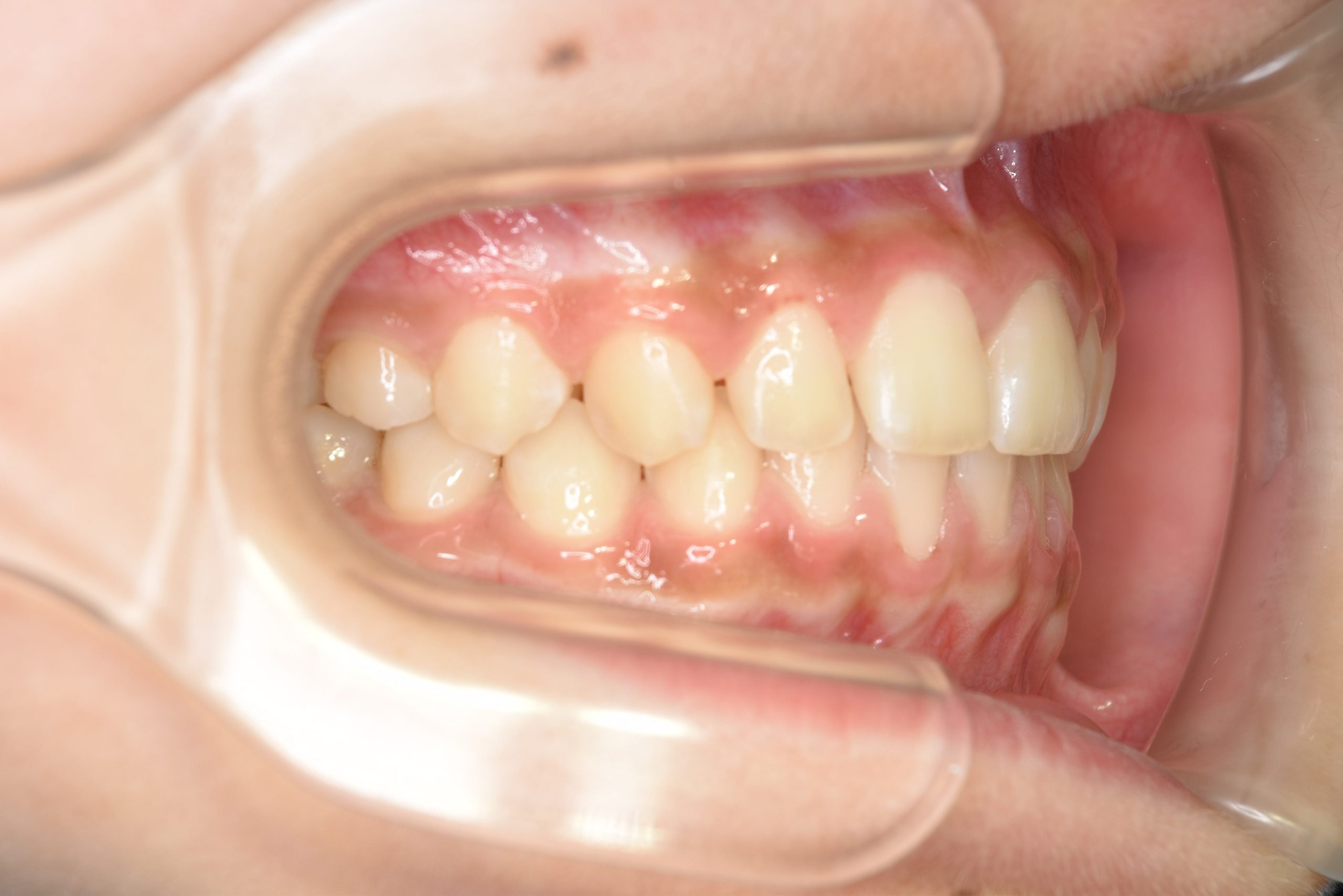 全顎ワイヤー矯正　症例_108