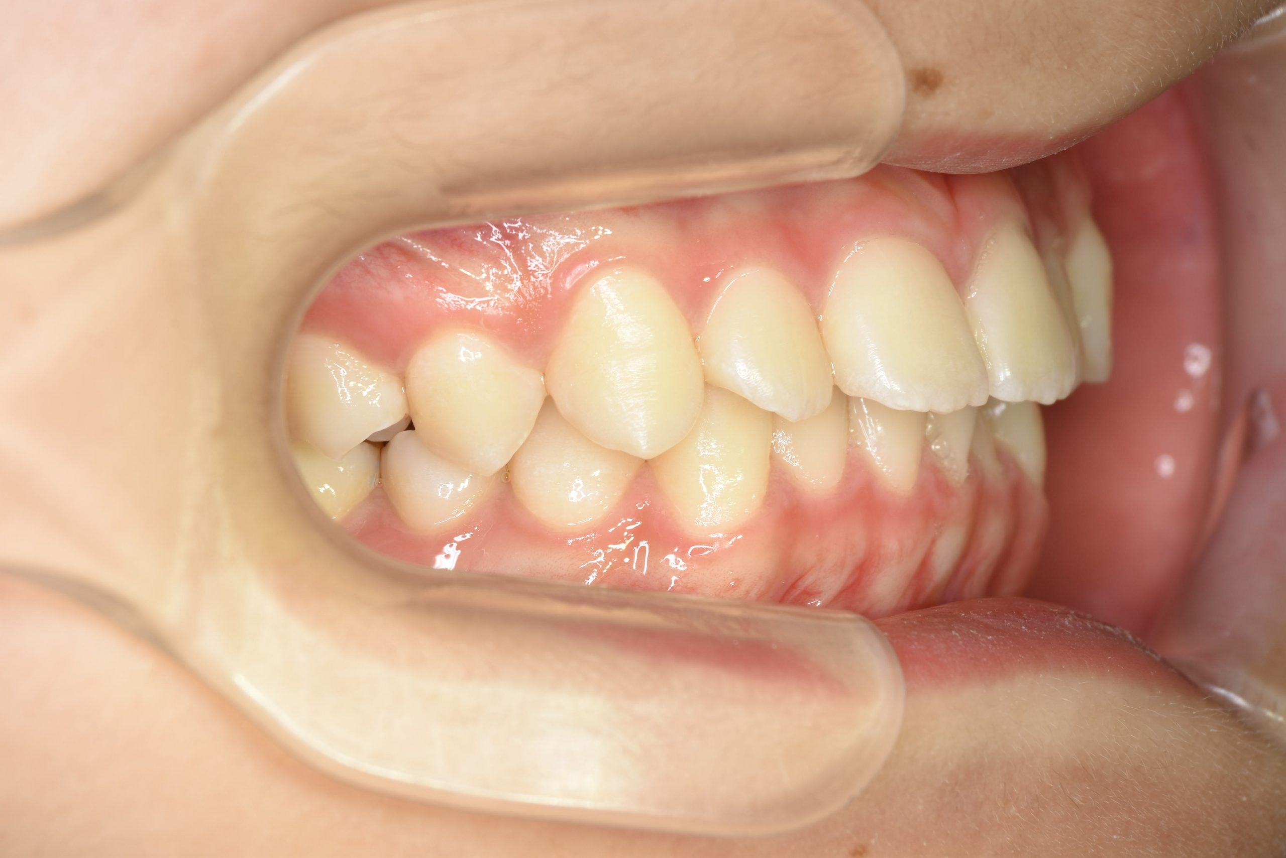 全顎ワイヤー矯正　症例_185