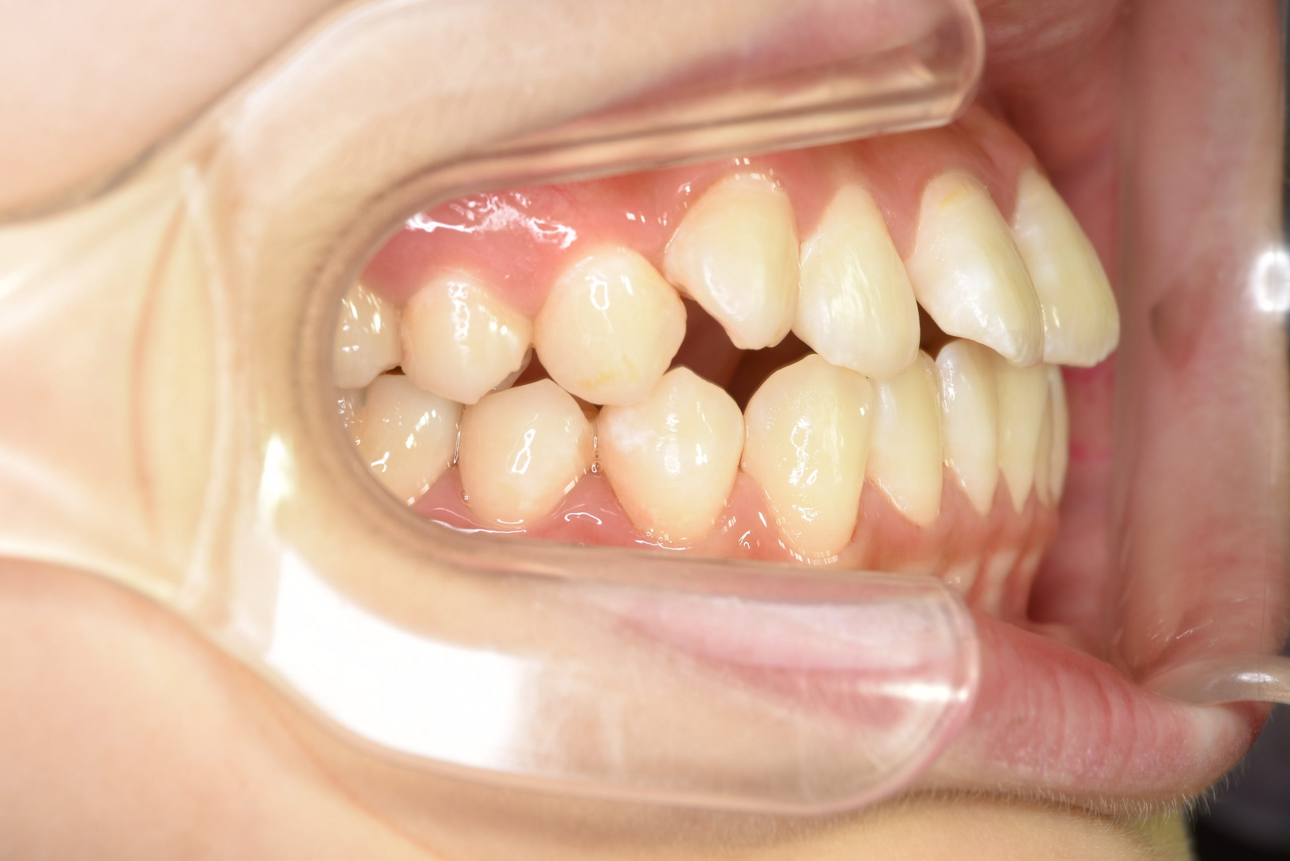 全顎ワイヤー矯正　症例_198