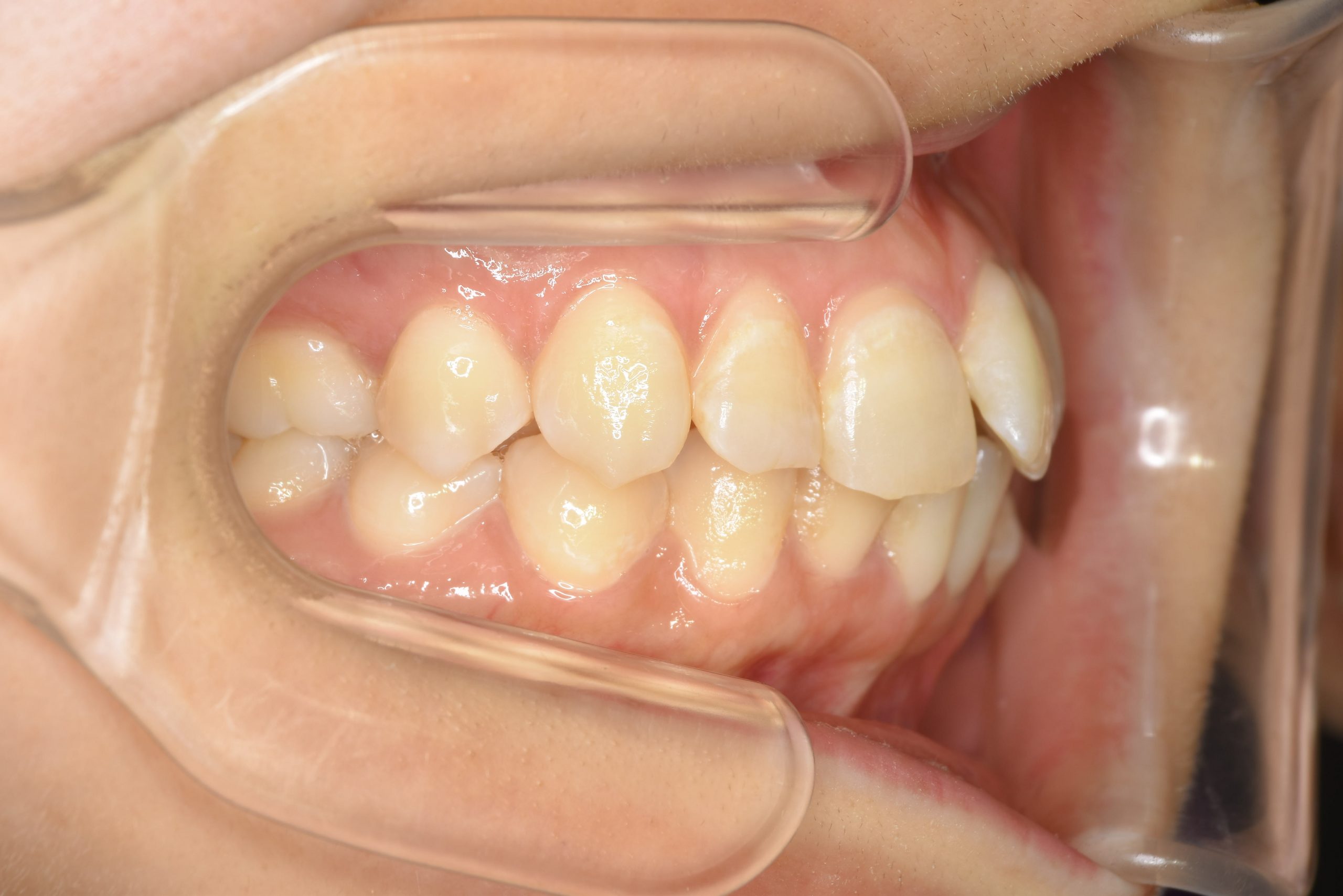 全顎ワイヤー矯正　症例_200