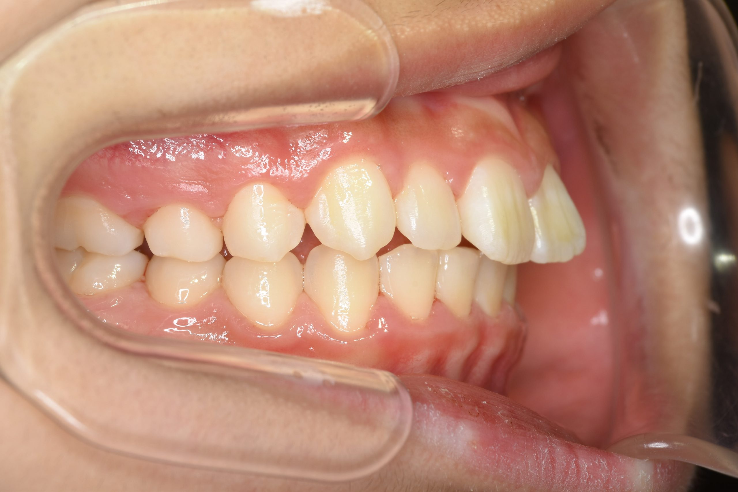 全顎ワイヤー矯正　症例_218