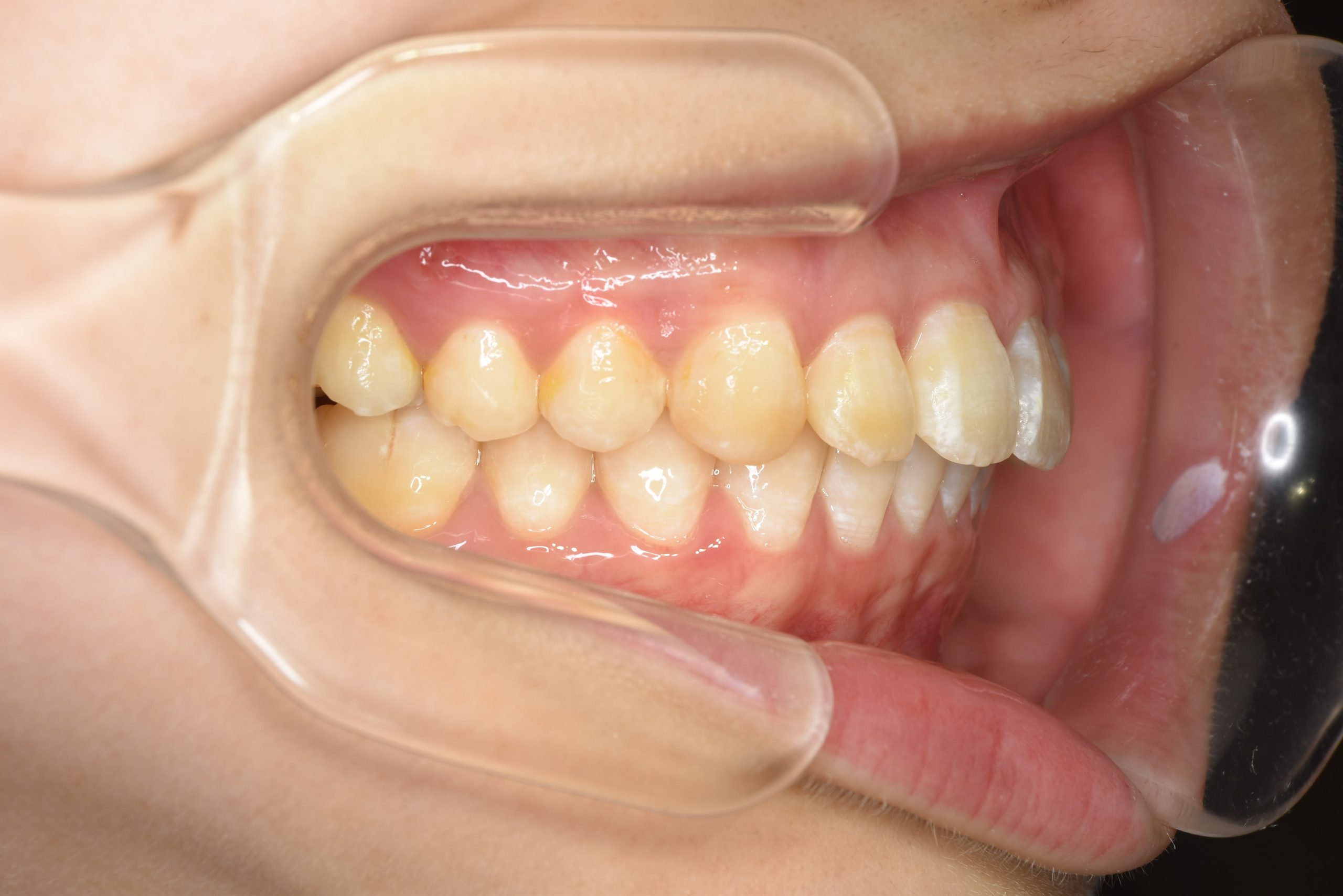 全顎ワイヤー矯正　症例_252