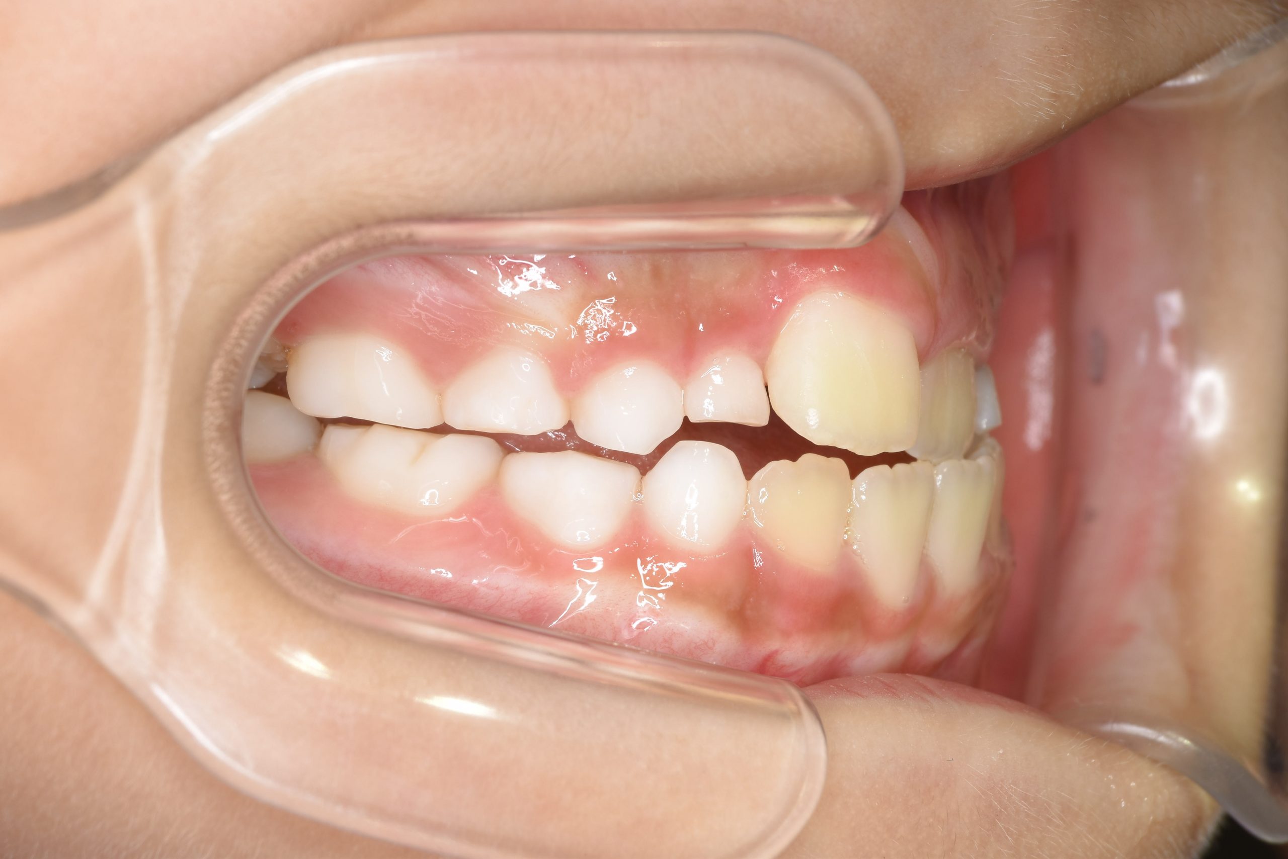 全顎ワイヤー矯正　症例_261