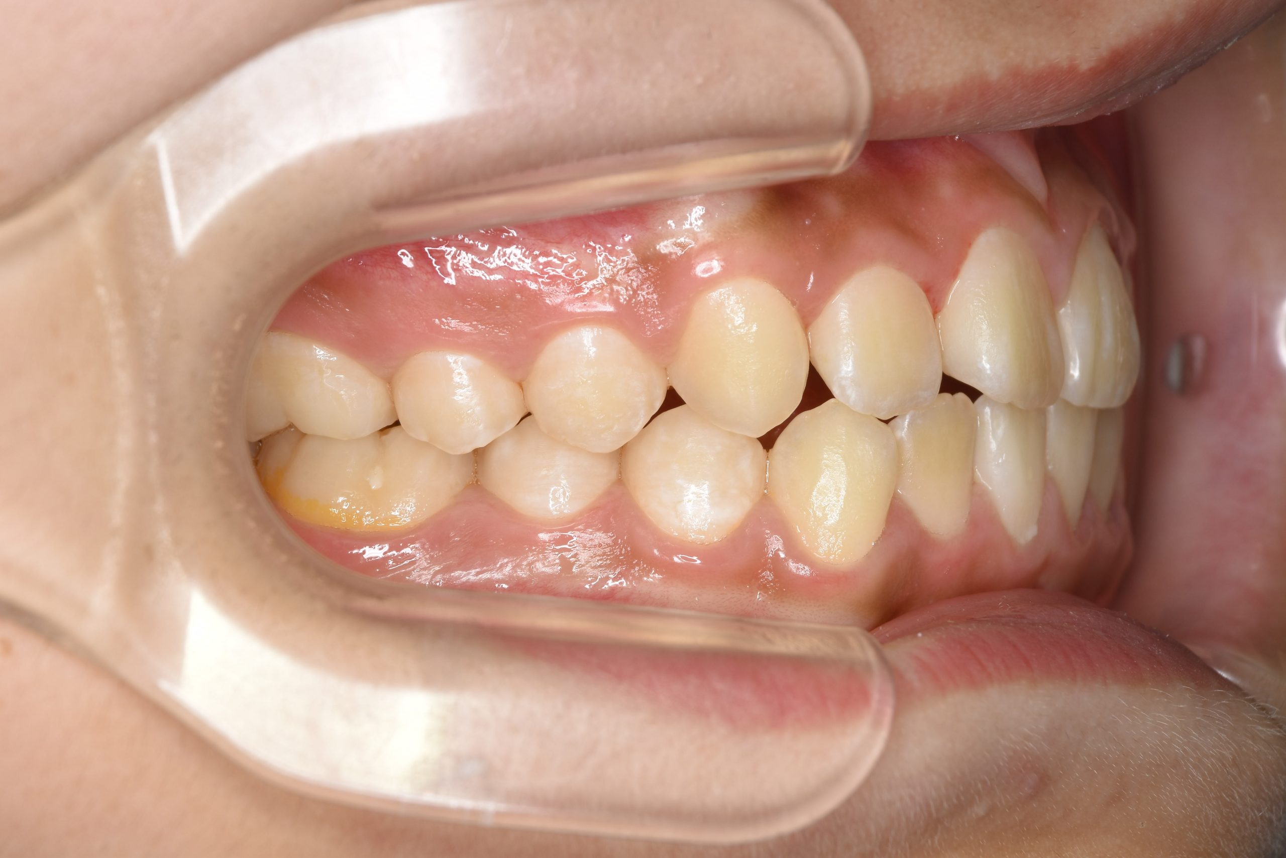 全顎ワイヤー矯正　症例_267