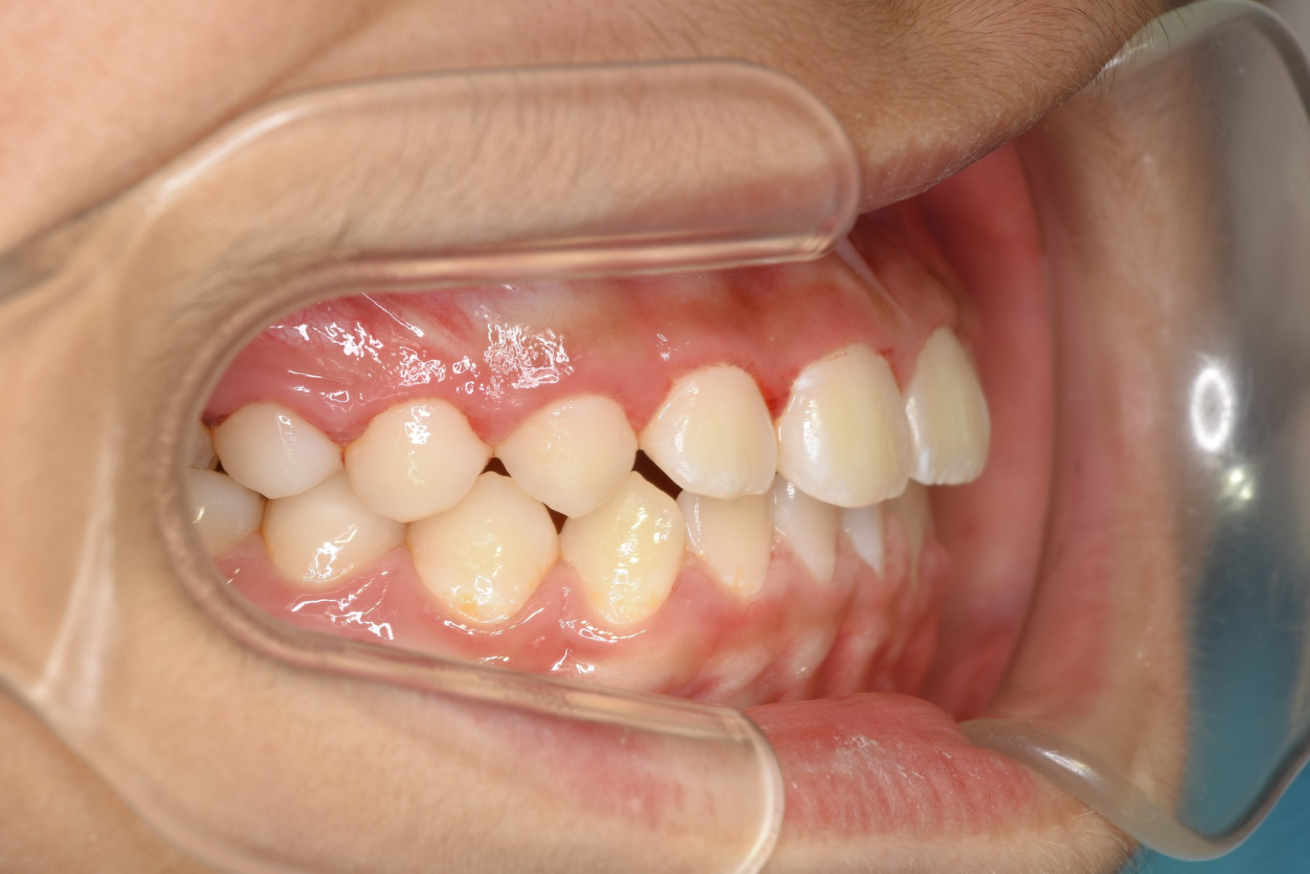 全顎ワイヤー矯正　症例_276