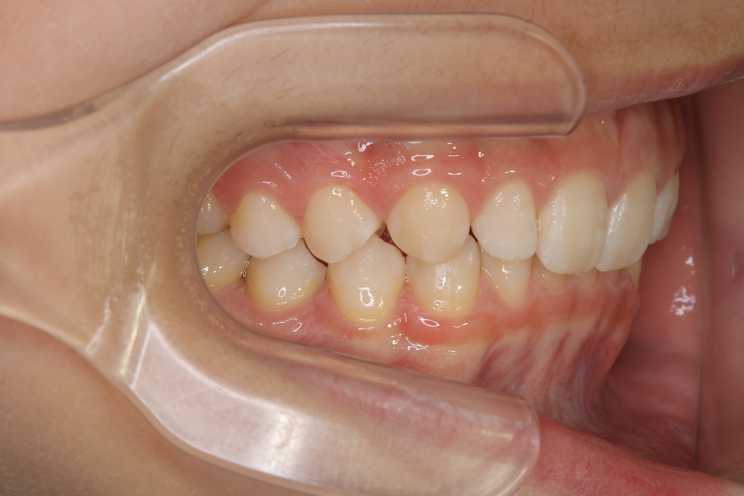 全顎ワイヤー矯正　症例_121