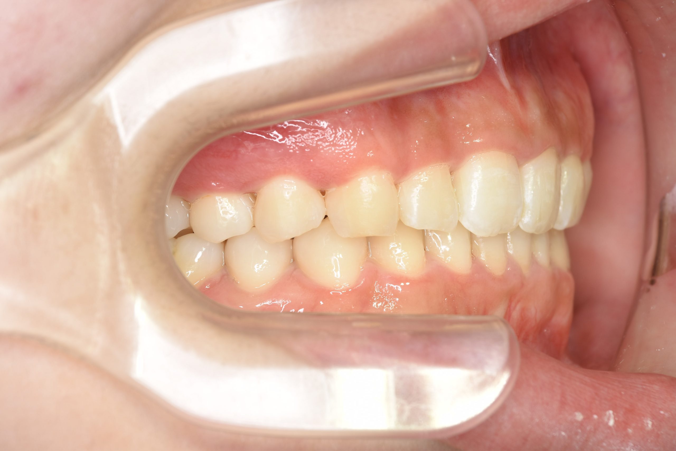 全顎ワイヤー矯正　症例_315