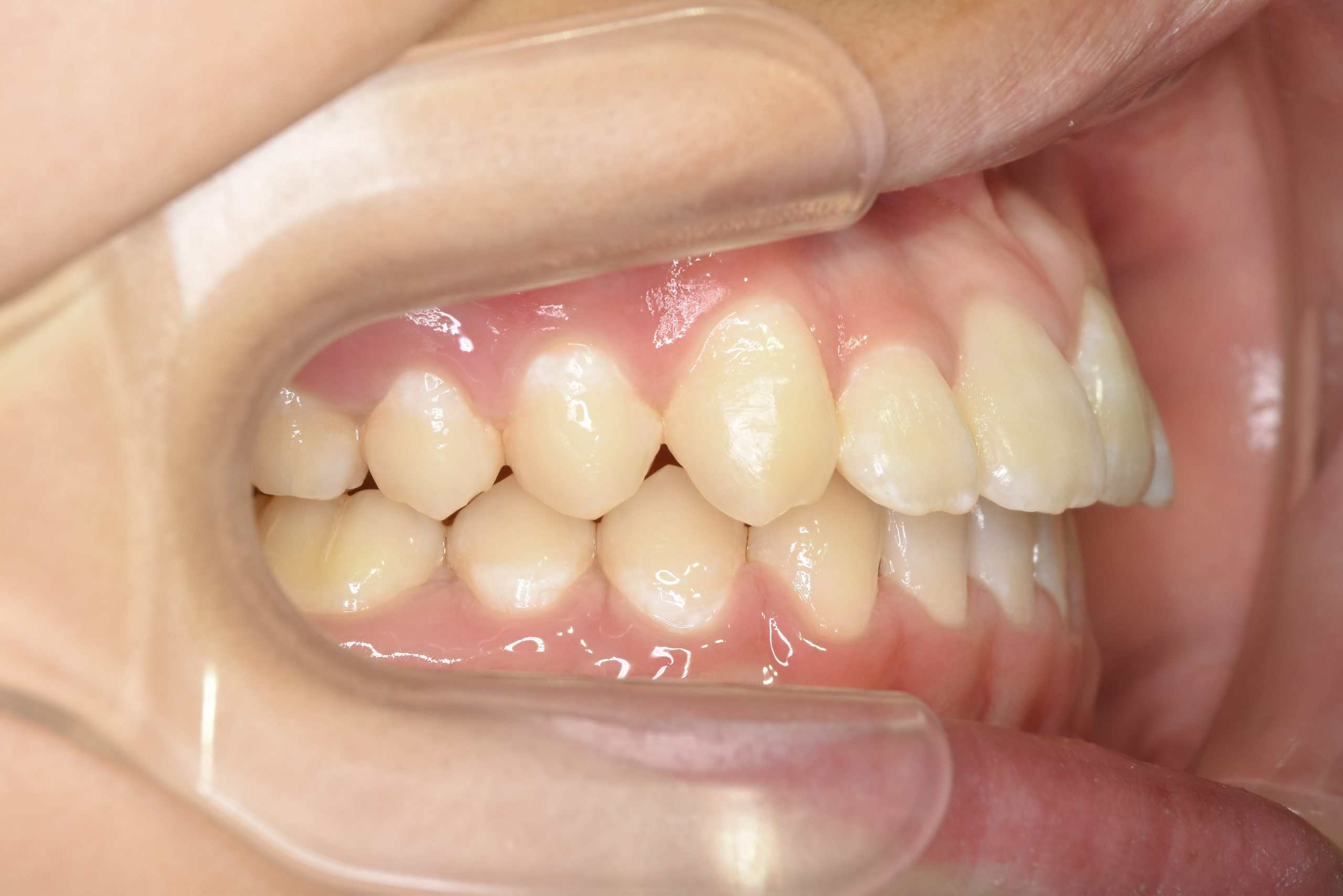 全顎ワイヤー矯正　症例_323