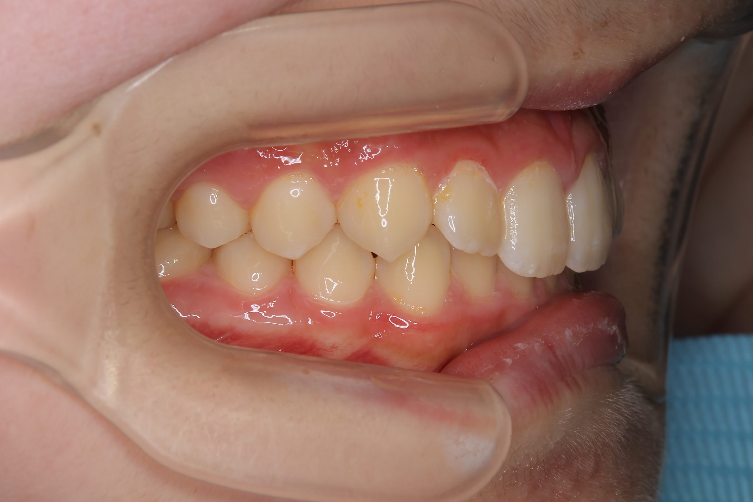 全顎ワイヤー矯正　症例_347