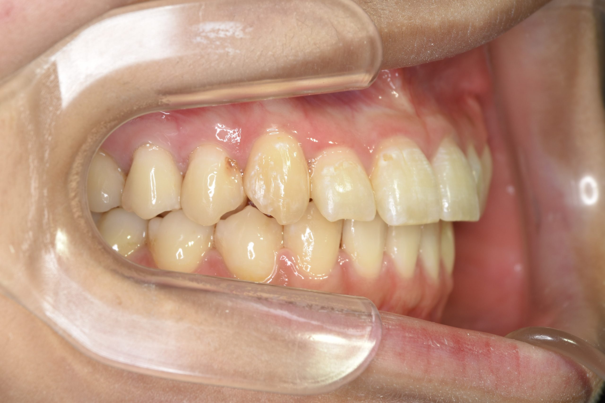 全顎ワイヤー矯正　症例_401