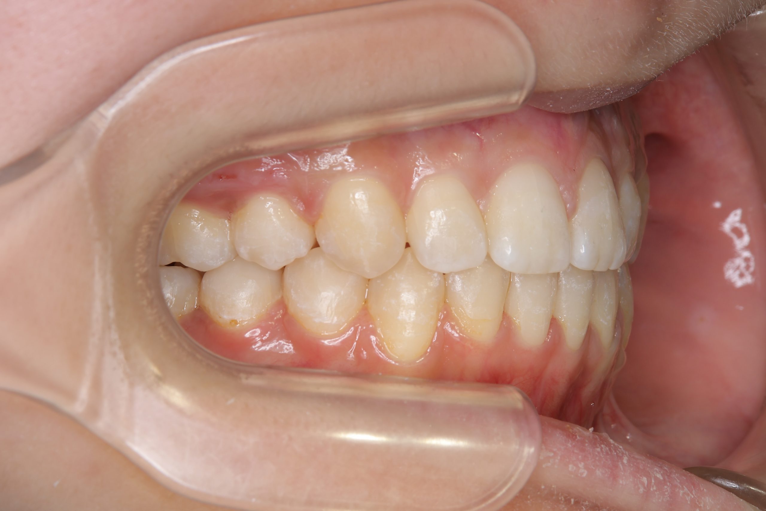 全顎ワイヤー矯正　症例_418