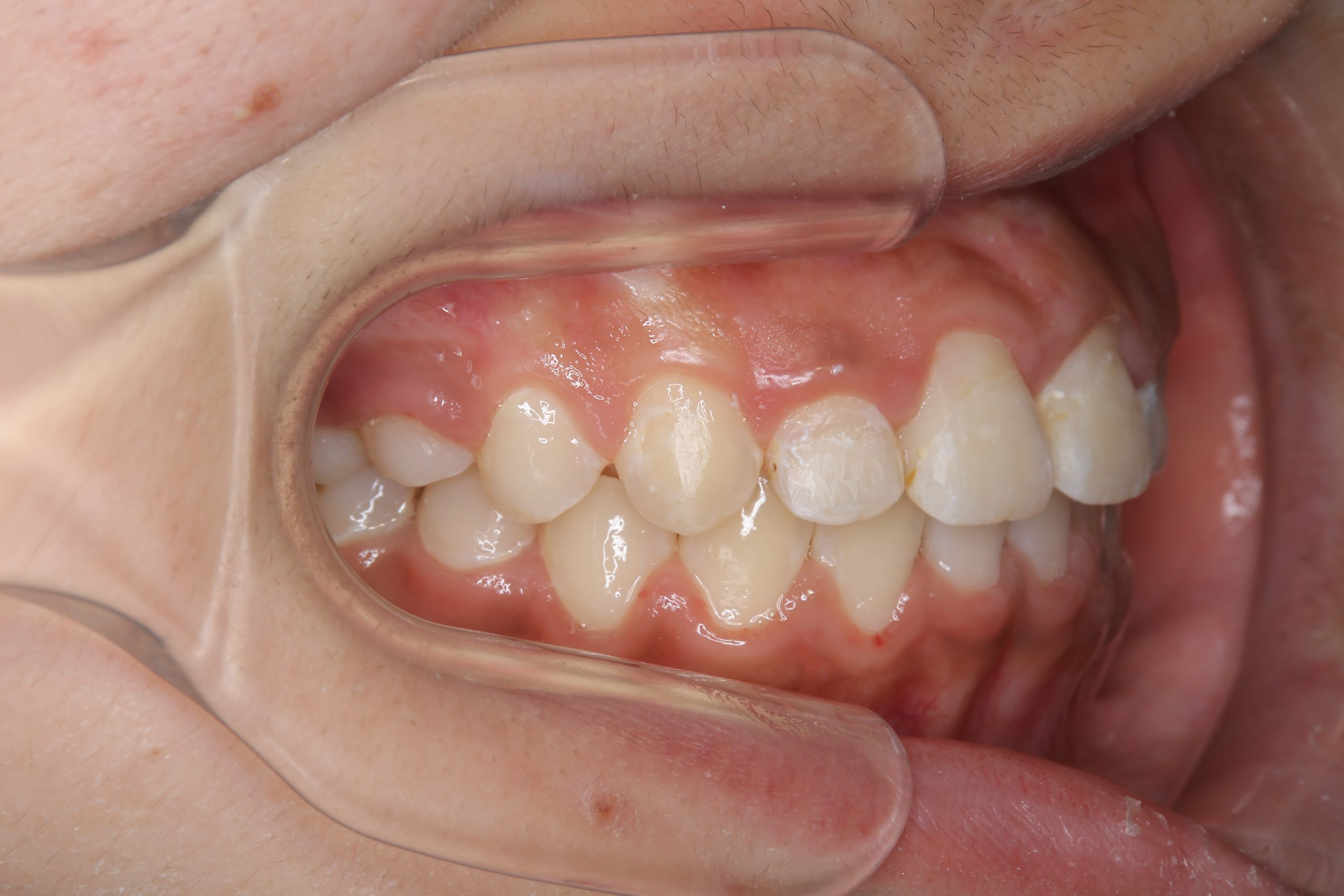 全顎ワイヤー矯正　症例_474