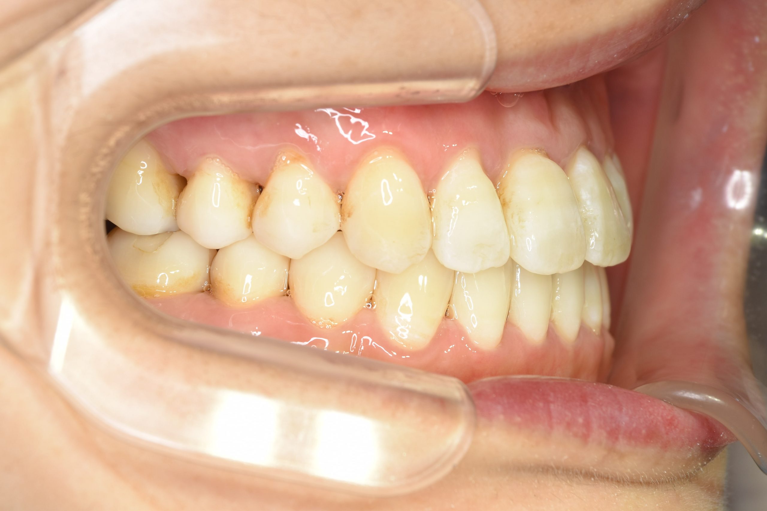 全顎ワイヤー矯正　症例_138