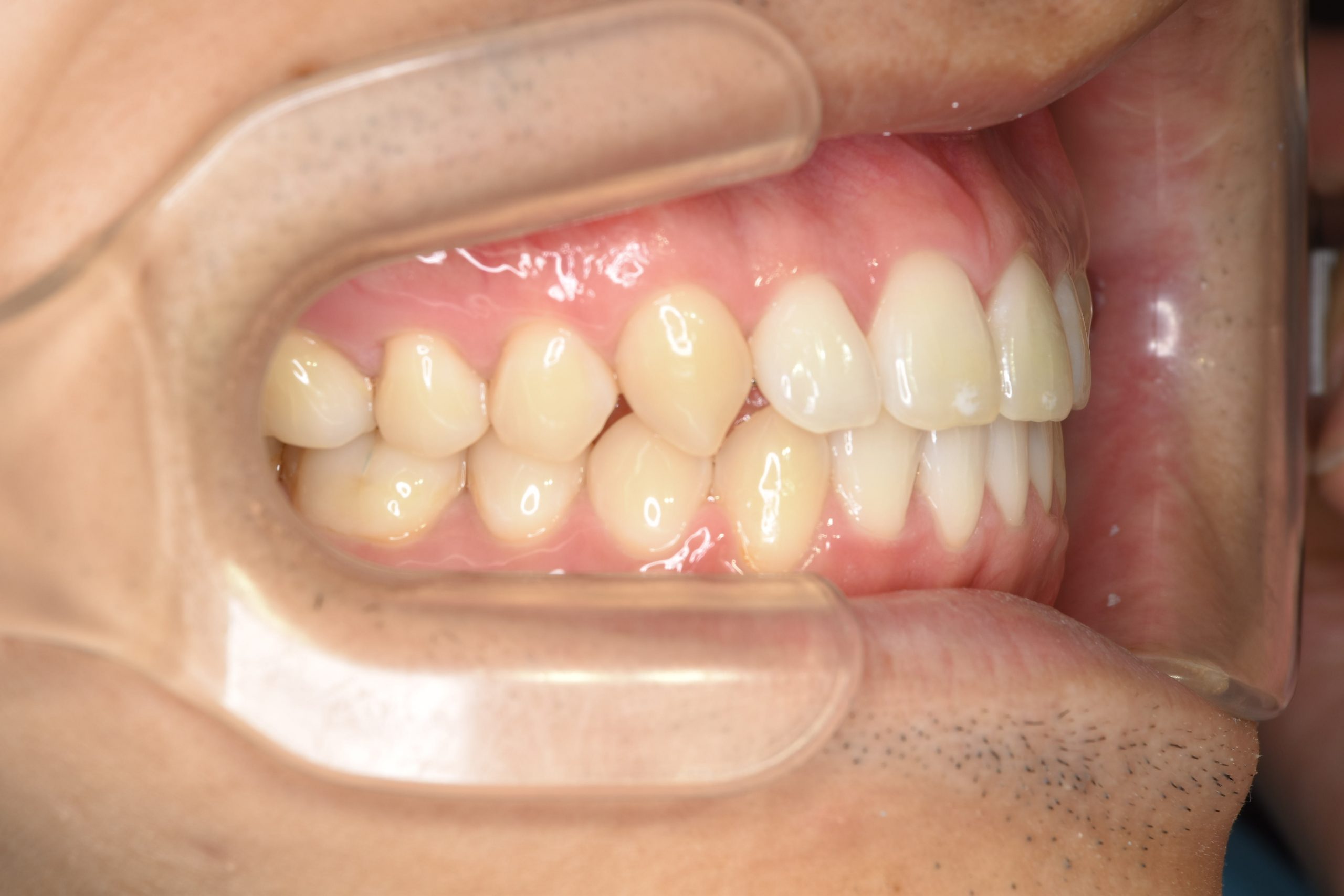 全顎ワイヤー矯正　症例_495