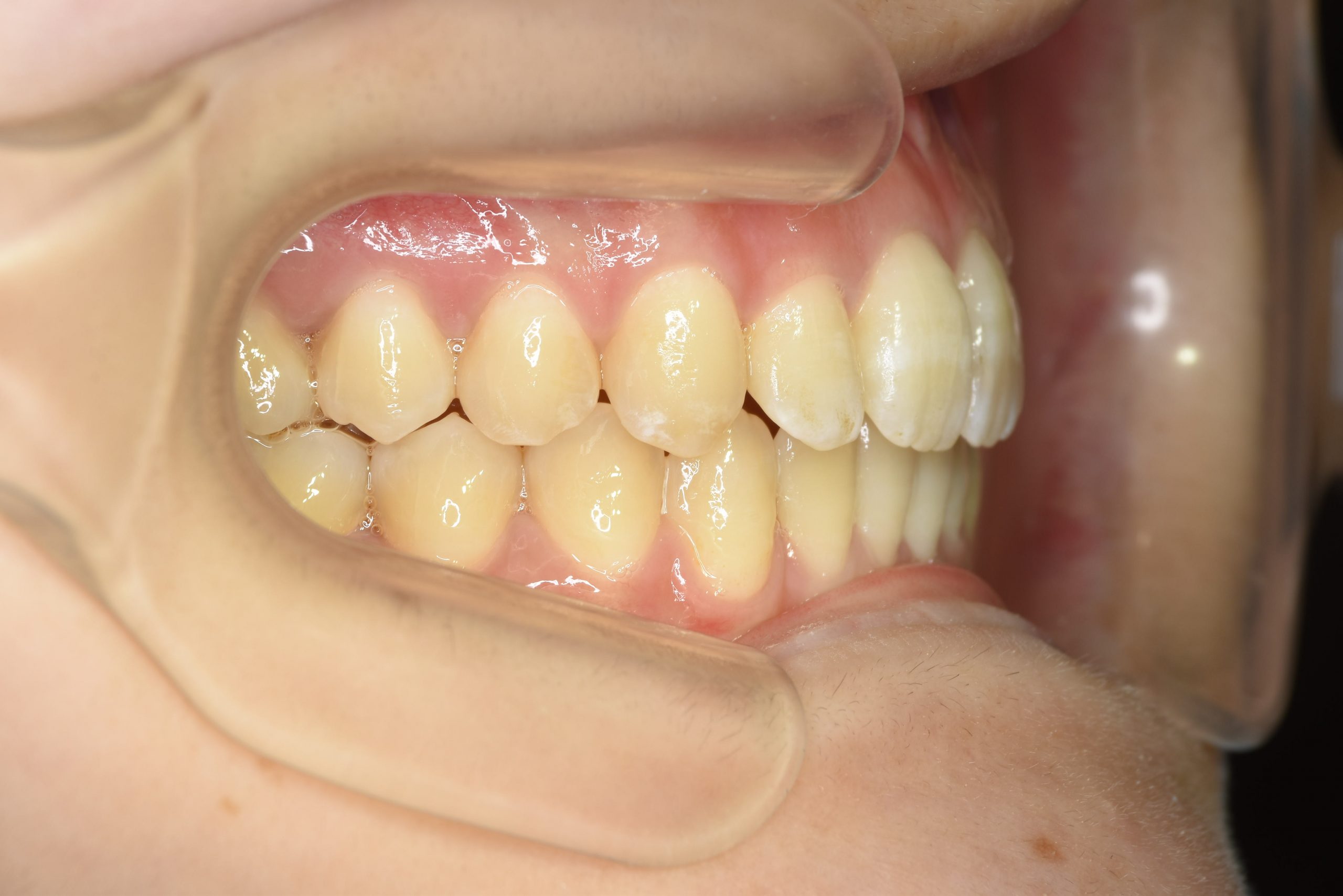 全顎ワイヤー矯正　症例_500