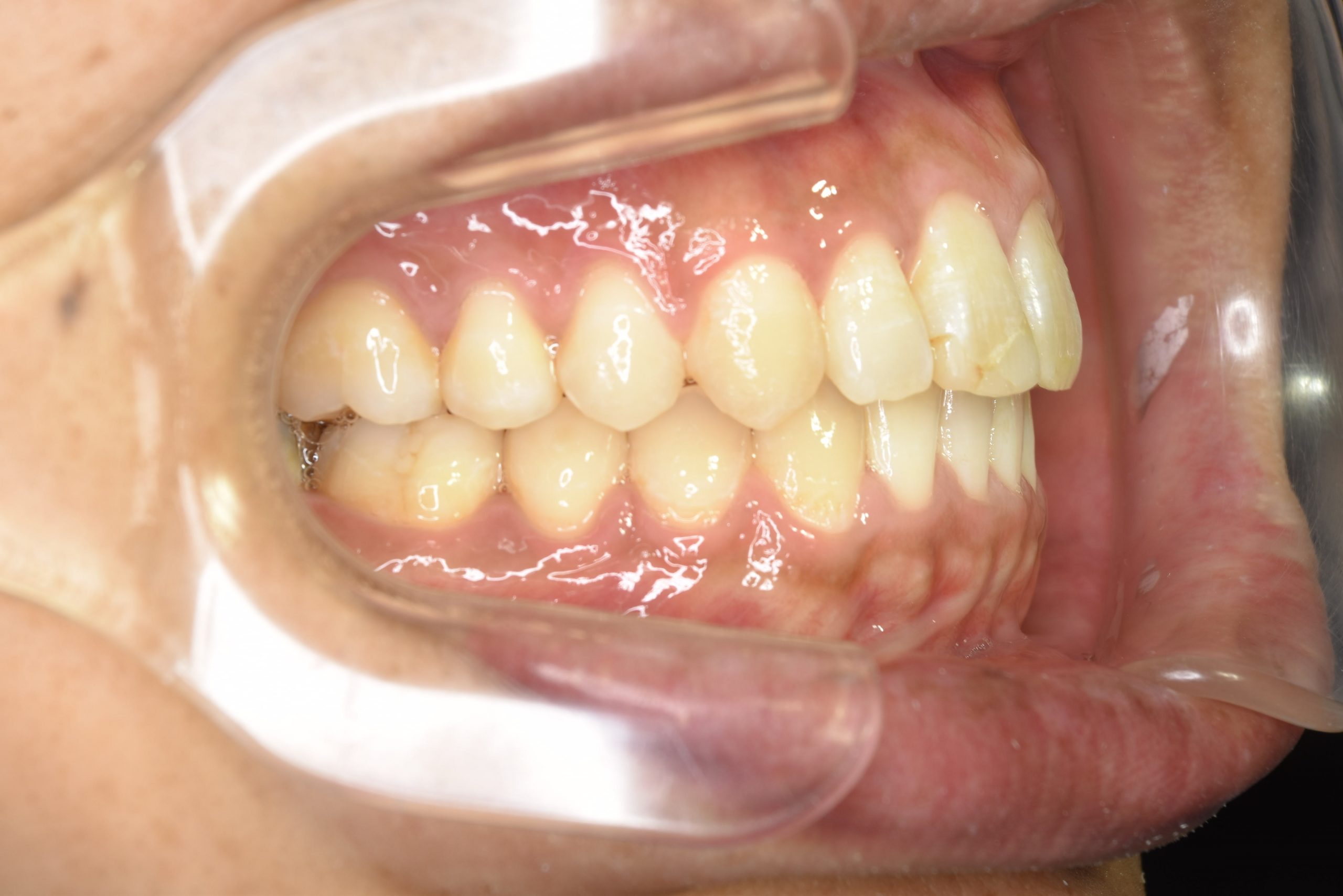 全顎ワイヤー矯正　症例_510