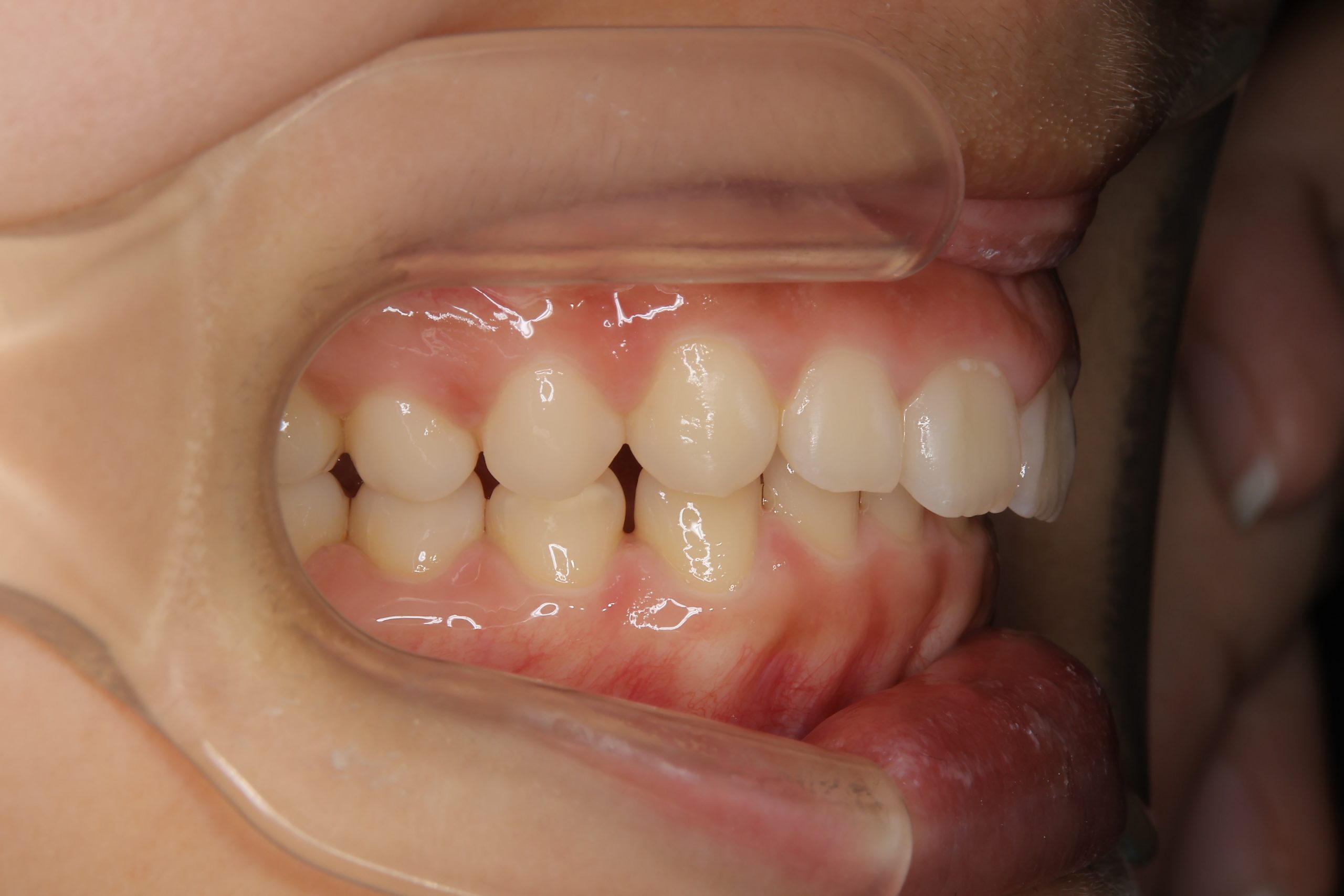 全顎ワイヤー矯正　症例_547