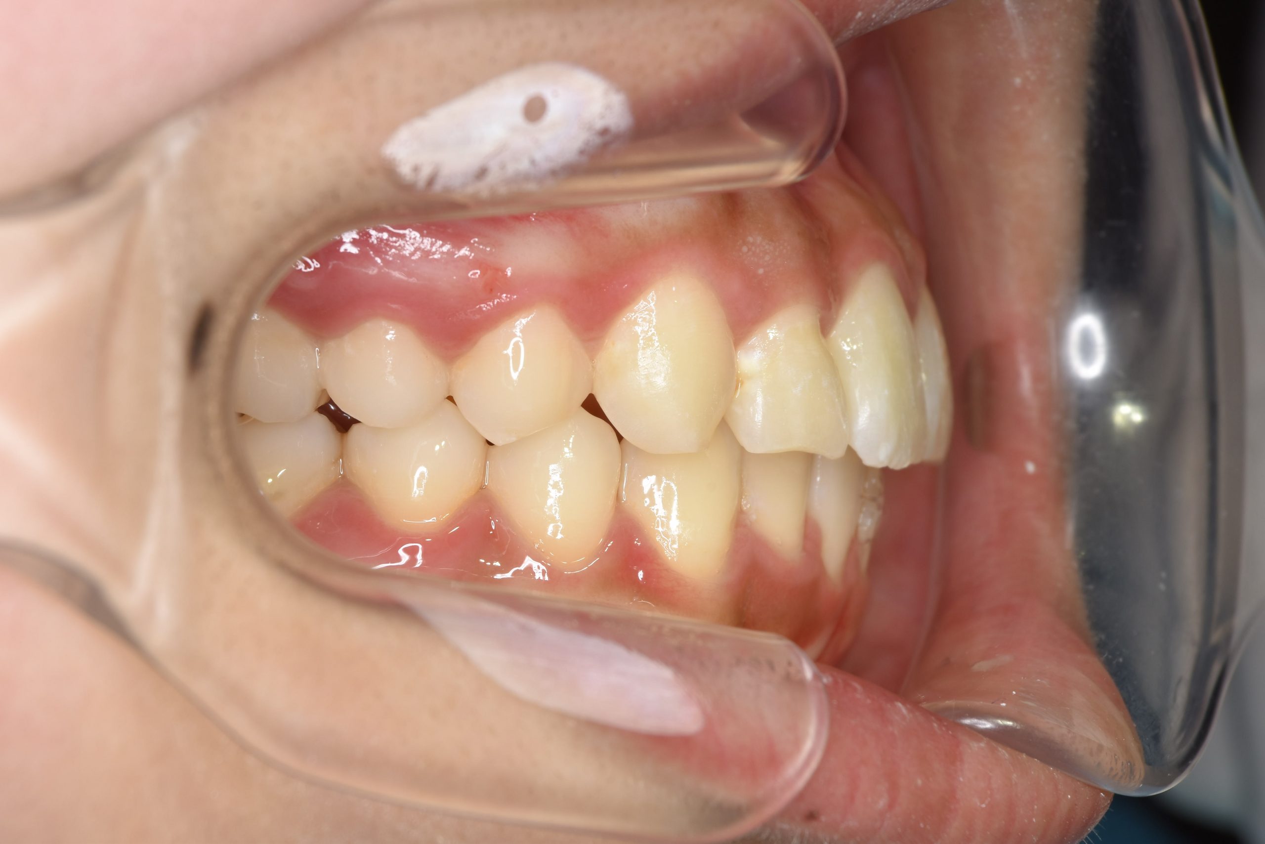 全顎ワイヤー矯正　症例_551