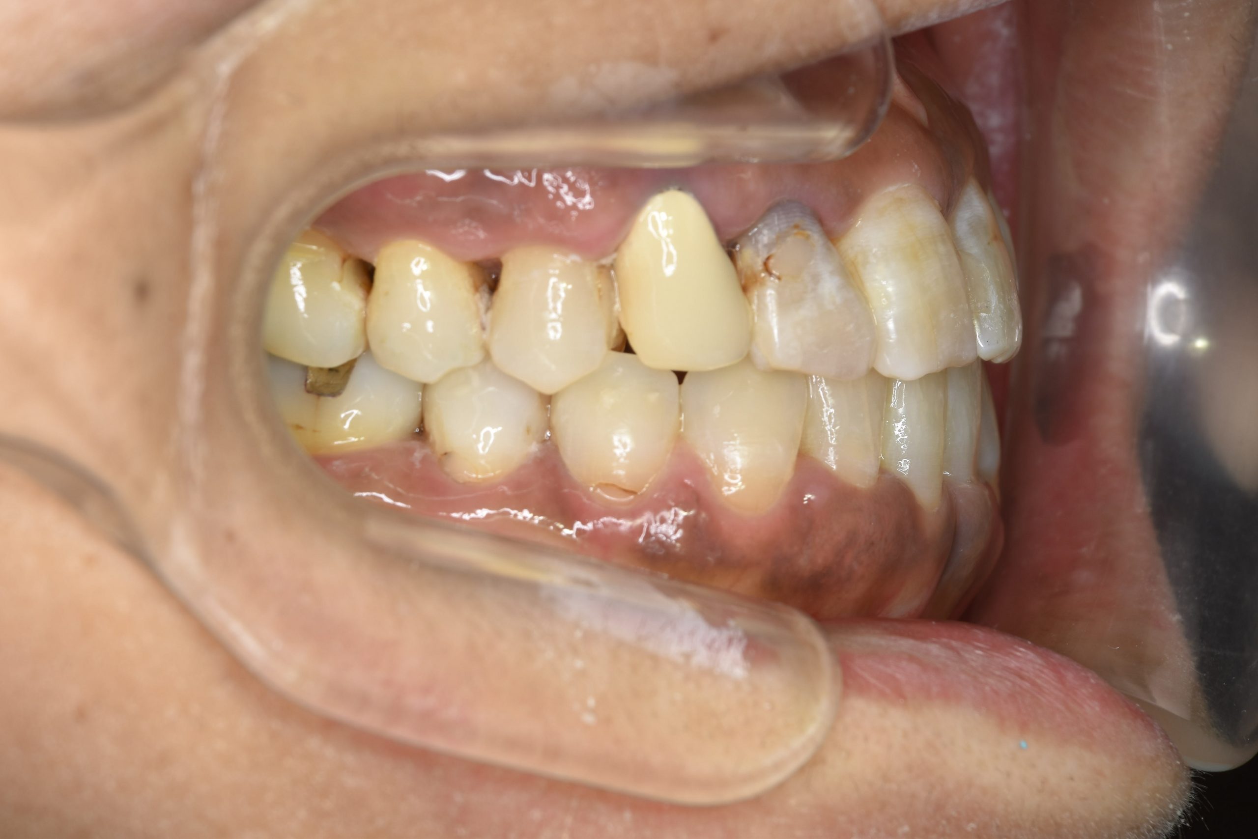 全顎ワイヤー矯正　症例_588