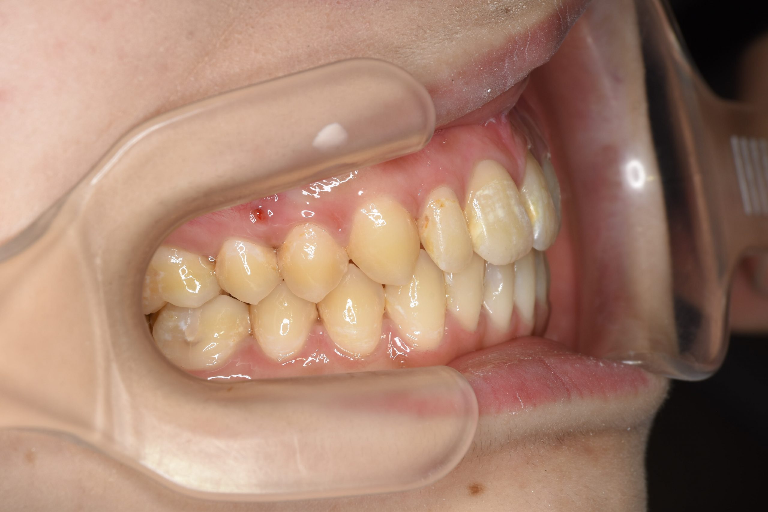 全顎ワイヤー矯正　症例_640