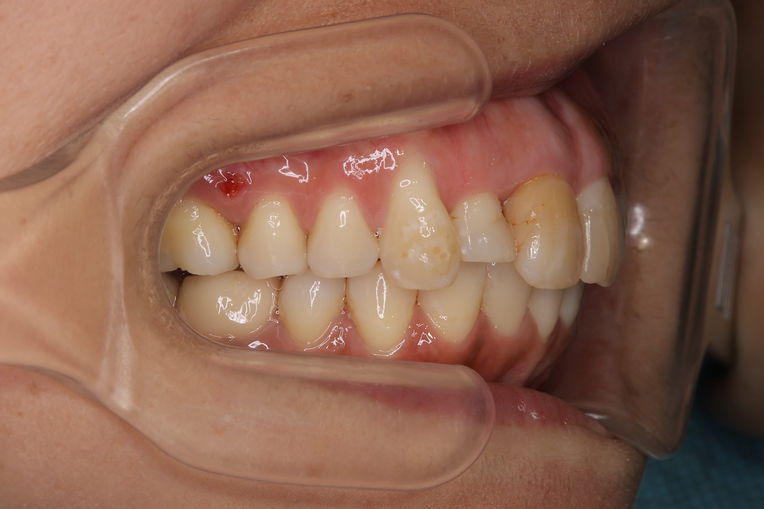 全顎ワイヤー矯正　症例_649