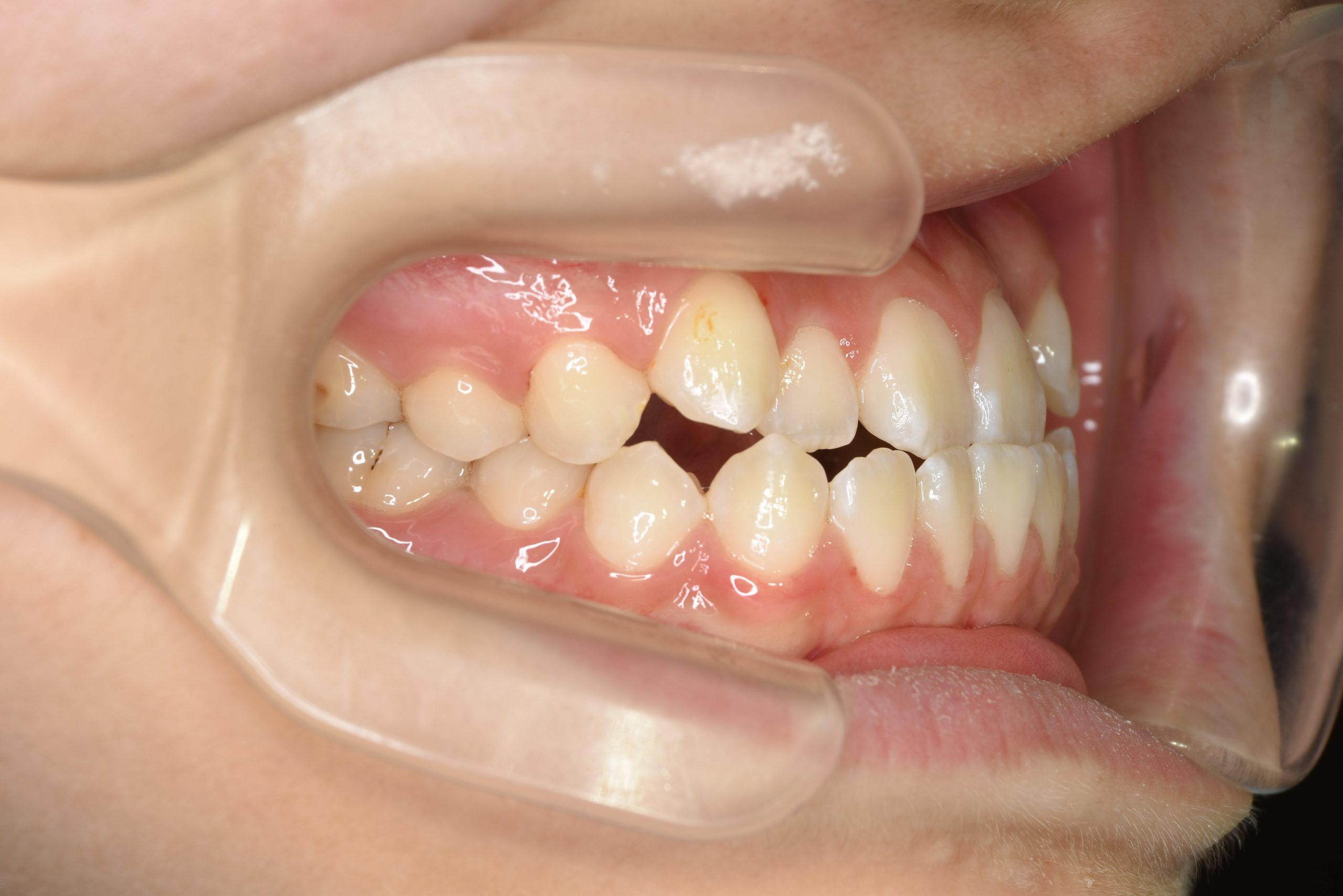 全顎ワイヤー矯正　症例_139