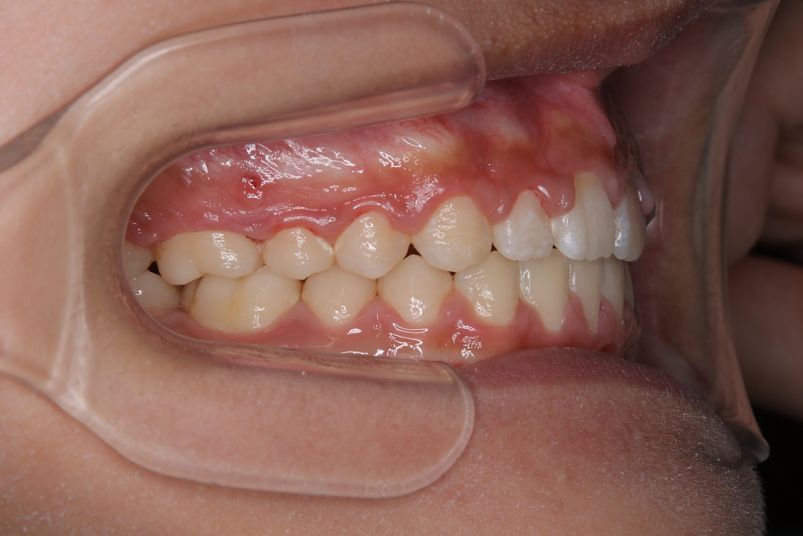 全顎ワイヤー矯正　症例_681