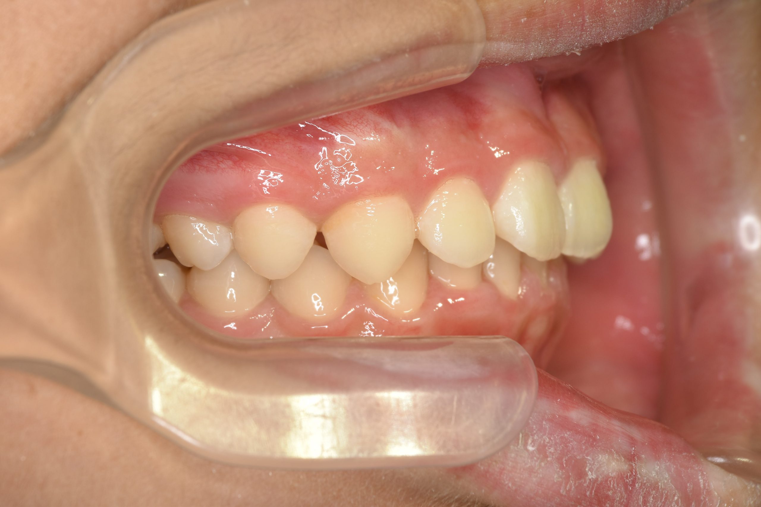 全顎ワイヤー矯正　症例_758