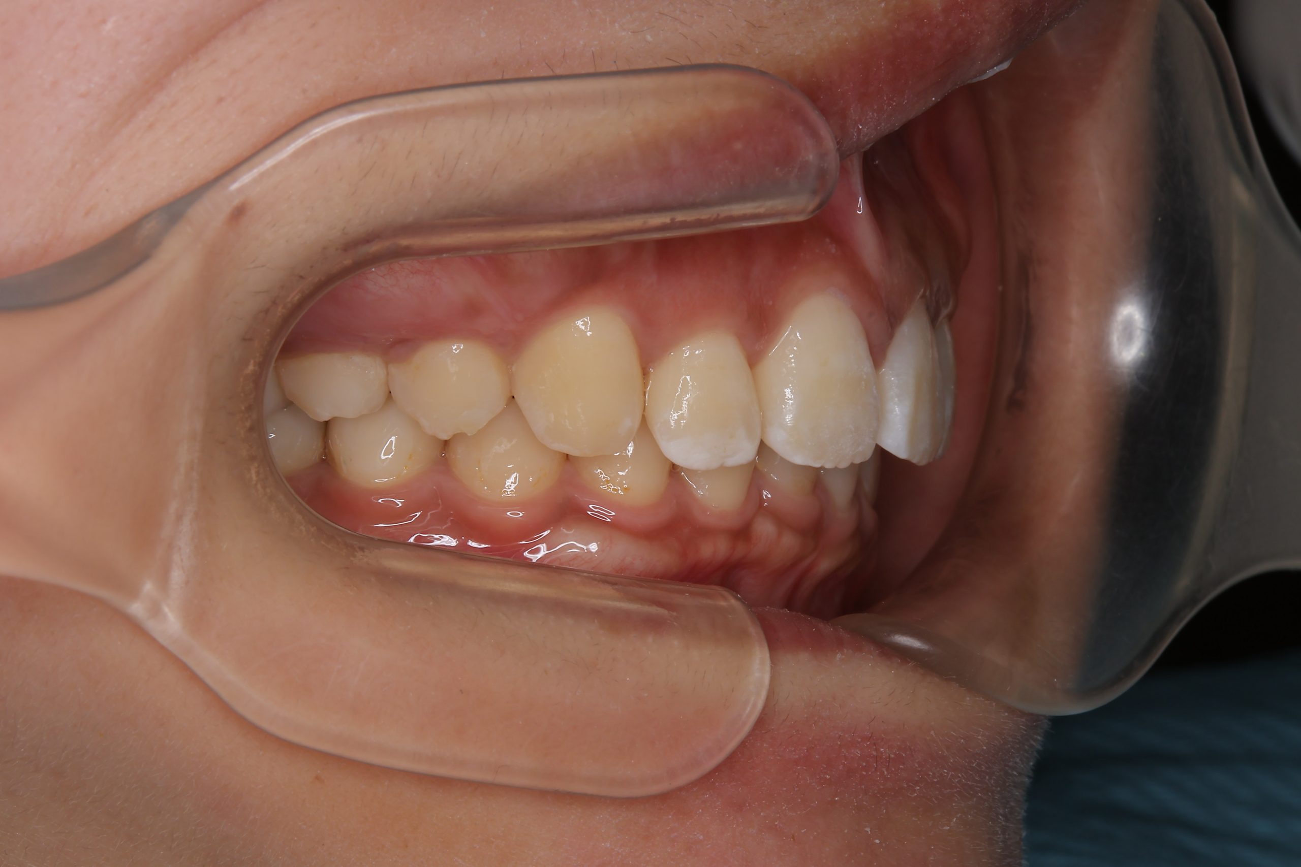 全顎ワイヤー矯正　症例_793