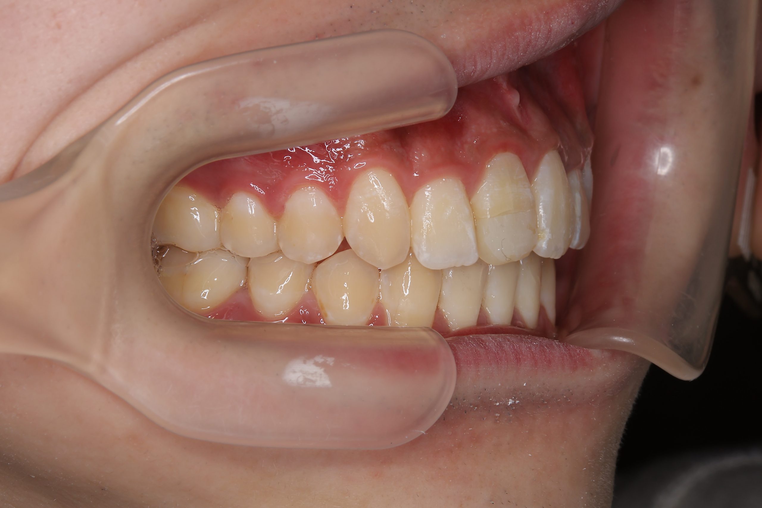 全顎ワイヤー矯正　症例_798