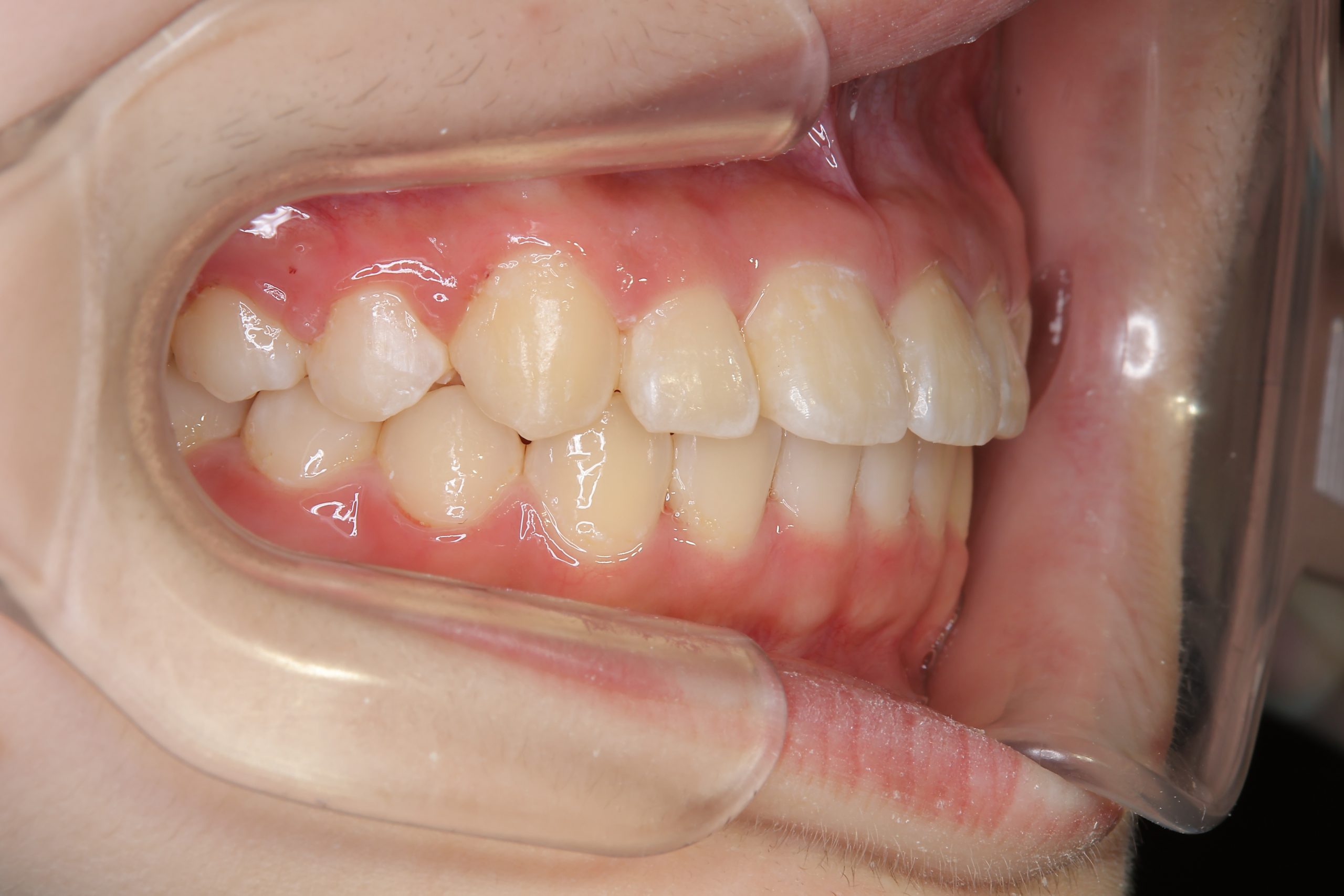 全顎ワイヤー矯正　症例_805