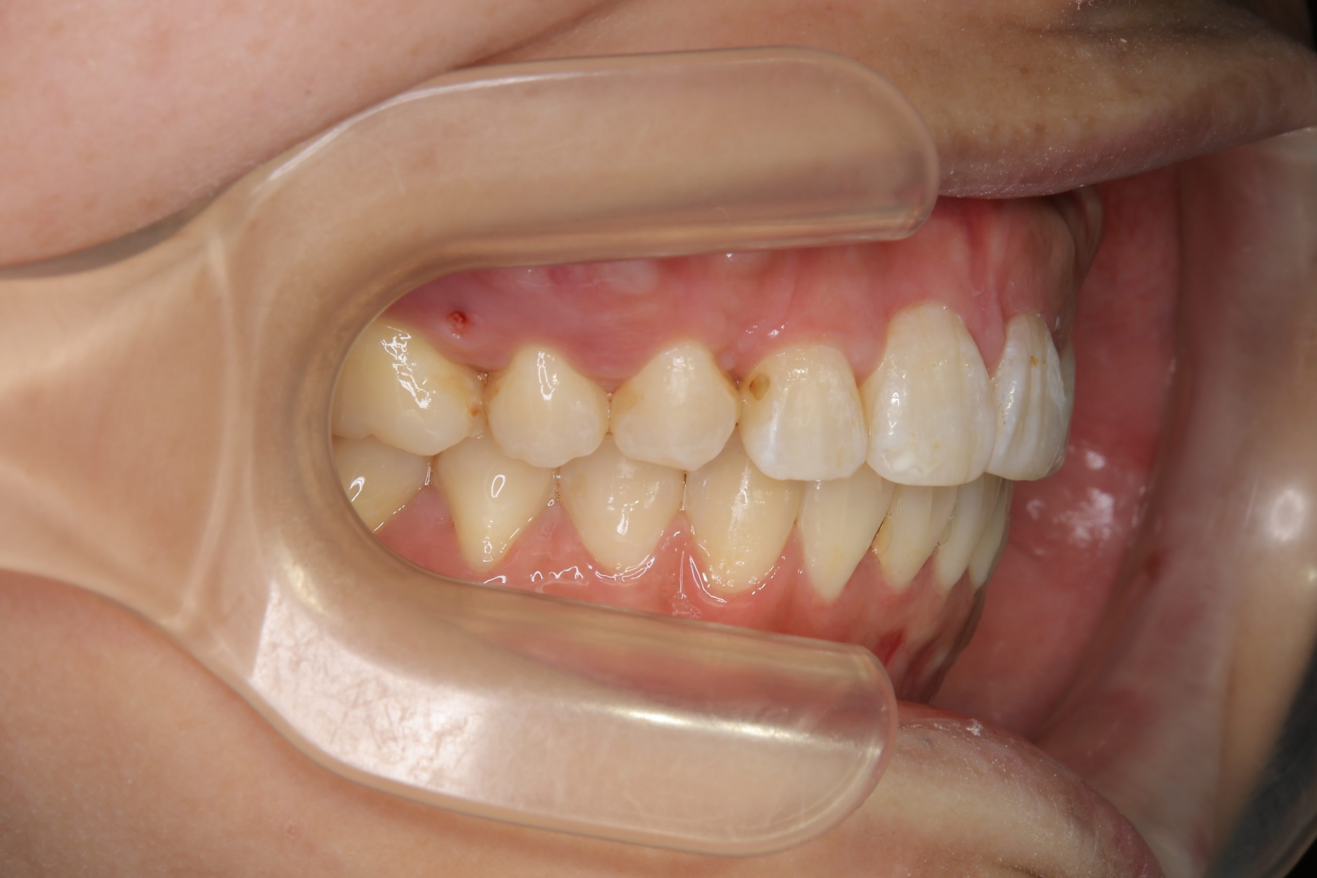 全顎ワイヤー矯正　症例_814