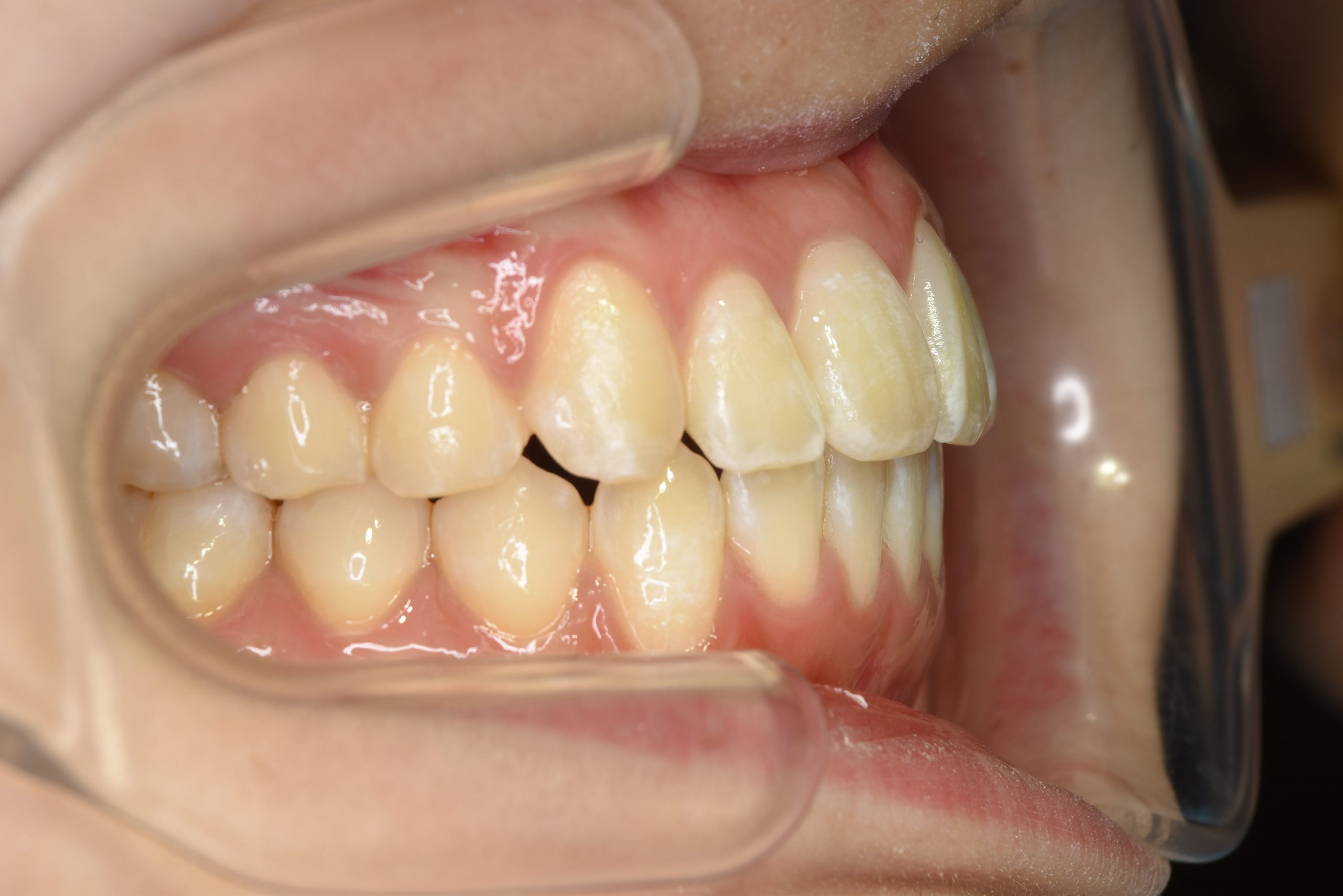 全顎ワイヤー矯正　症例_815