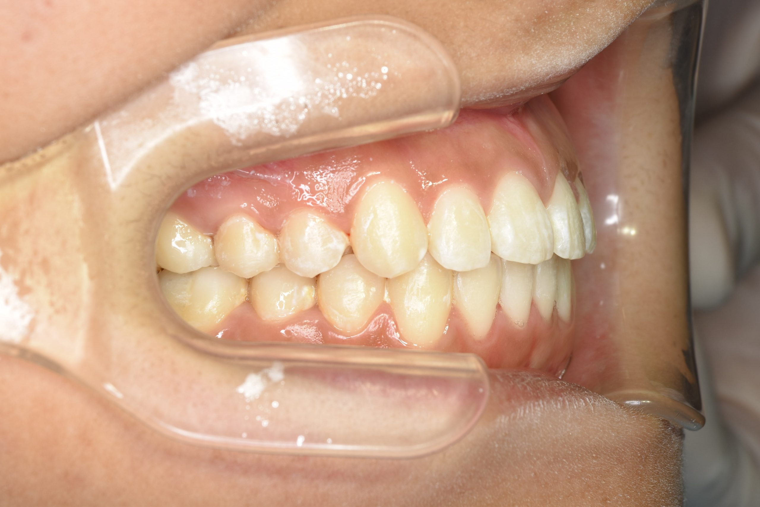 全顎ワイヤー矯正　症例_839