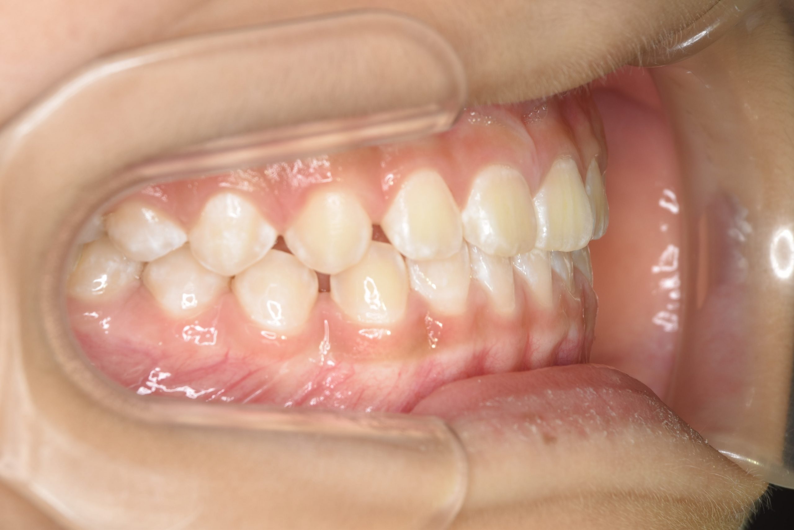 全顎ワイヤー矯正　症例_858