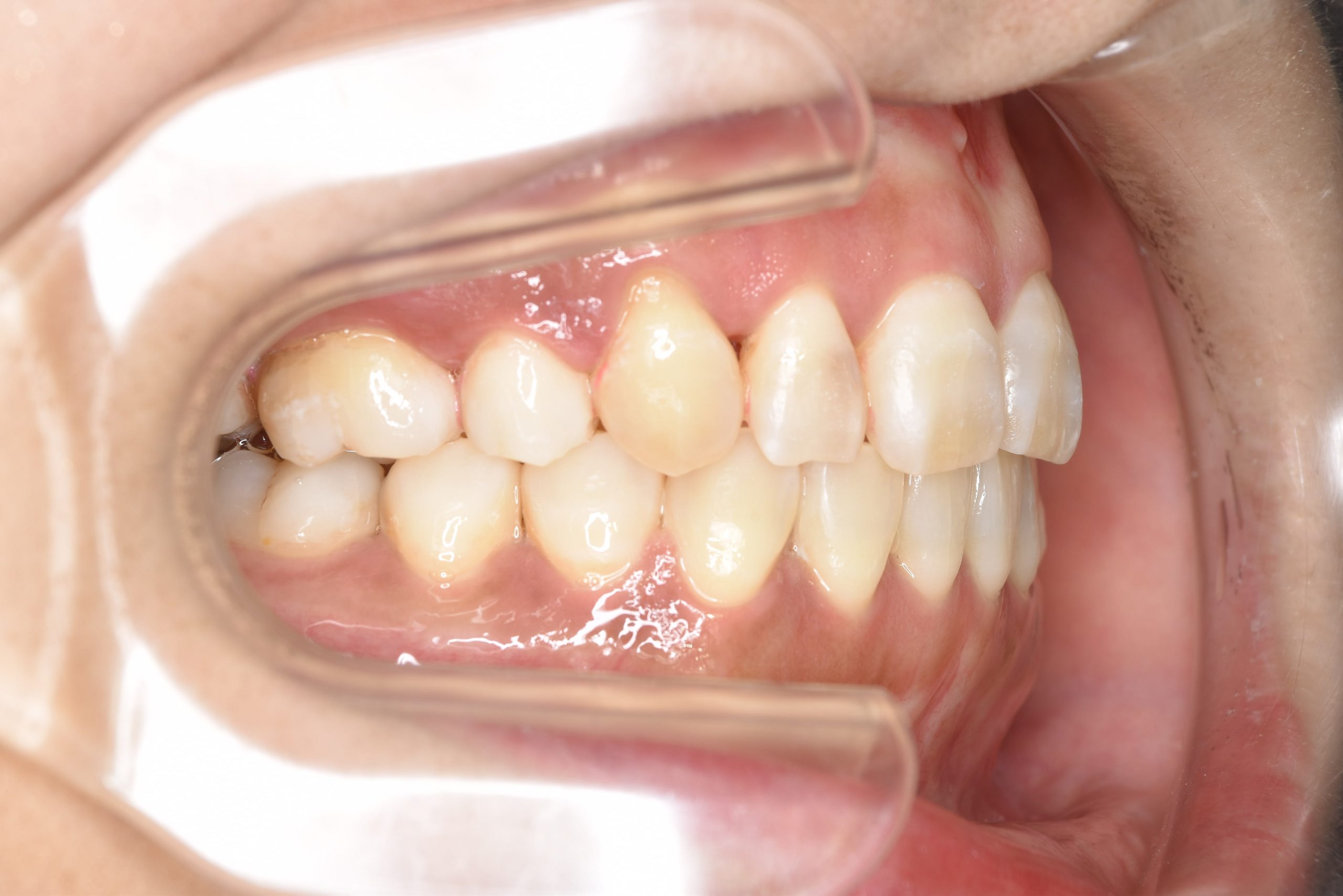 全顎ワイヤー矯正　症例_141