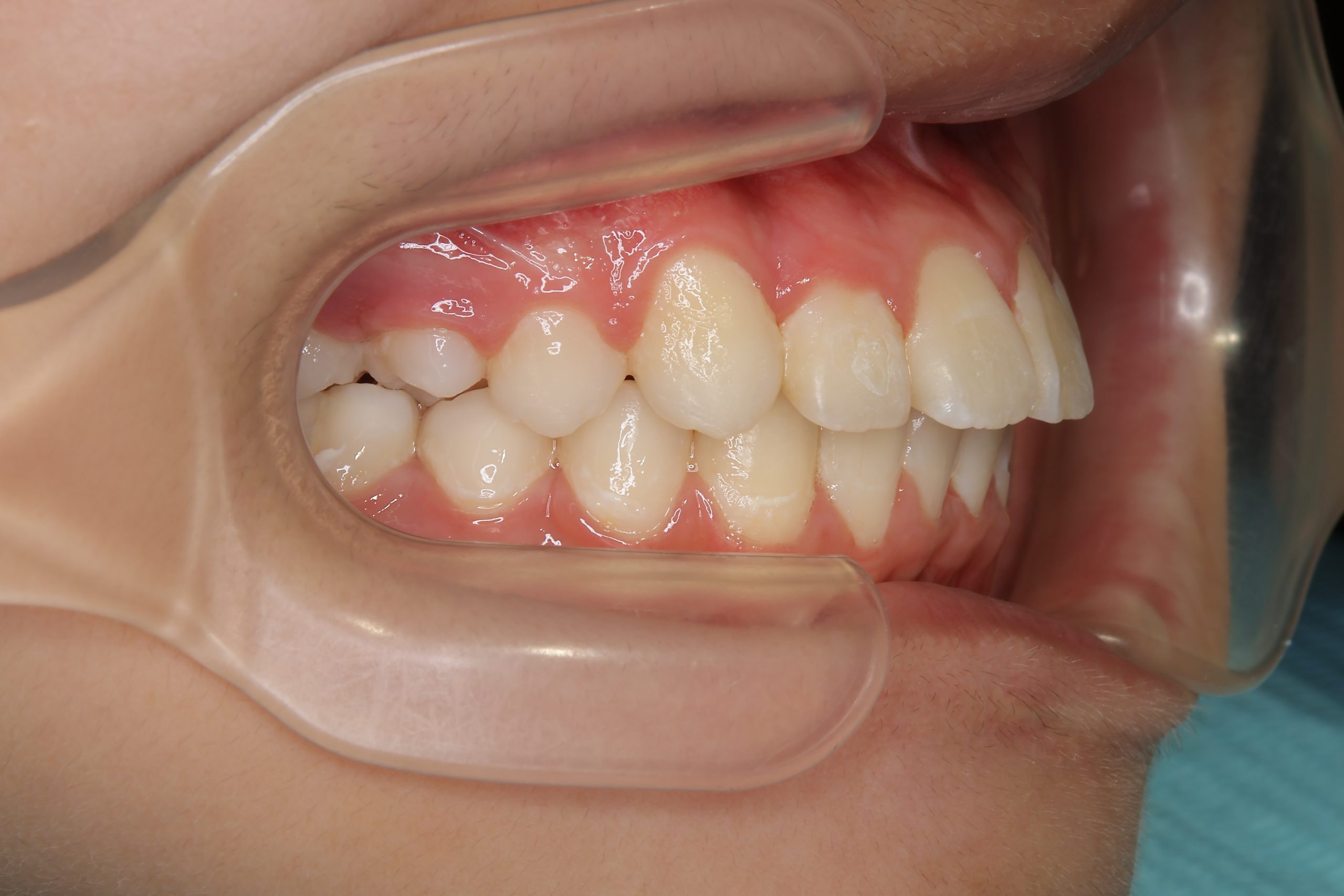 全顎ワイヤー矯正　症例_1324