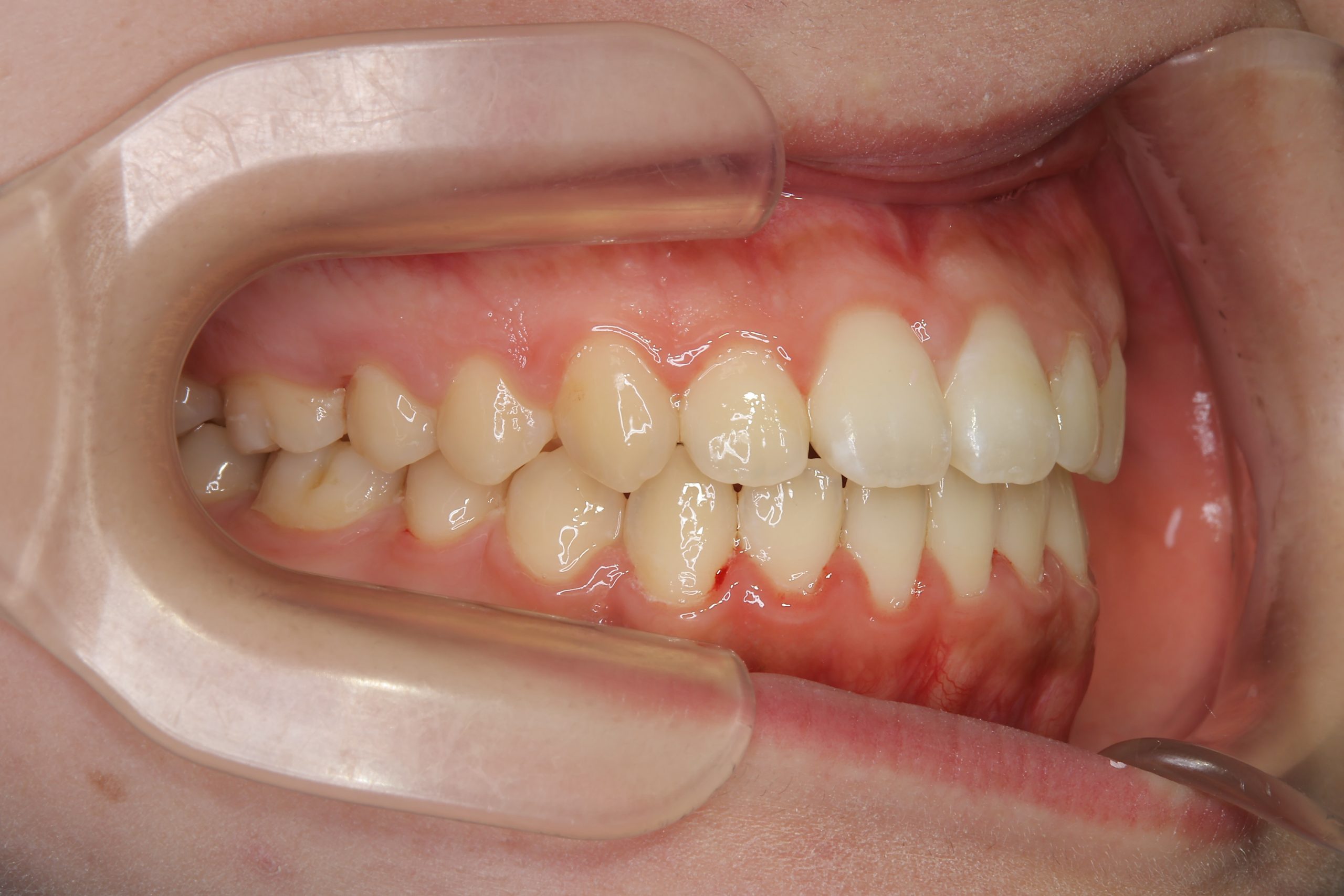 全顎ワイヤー矯正　症例_1409