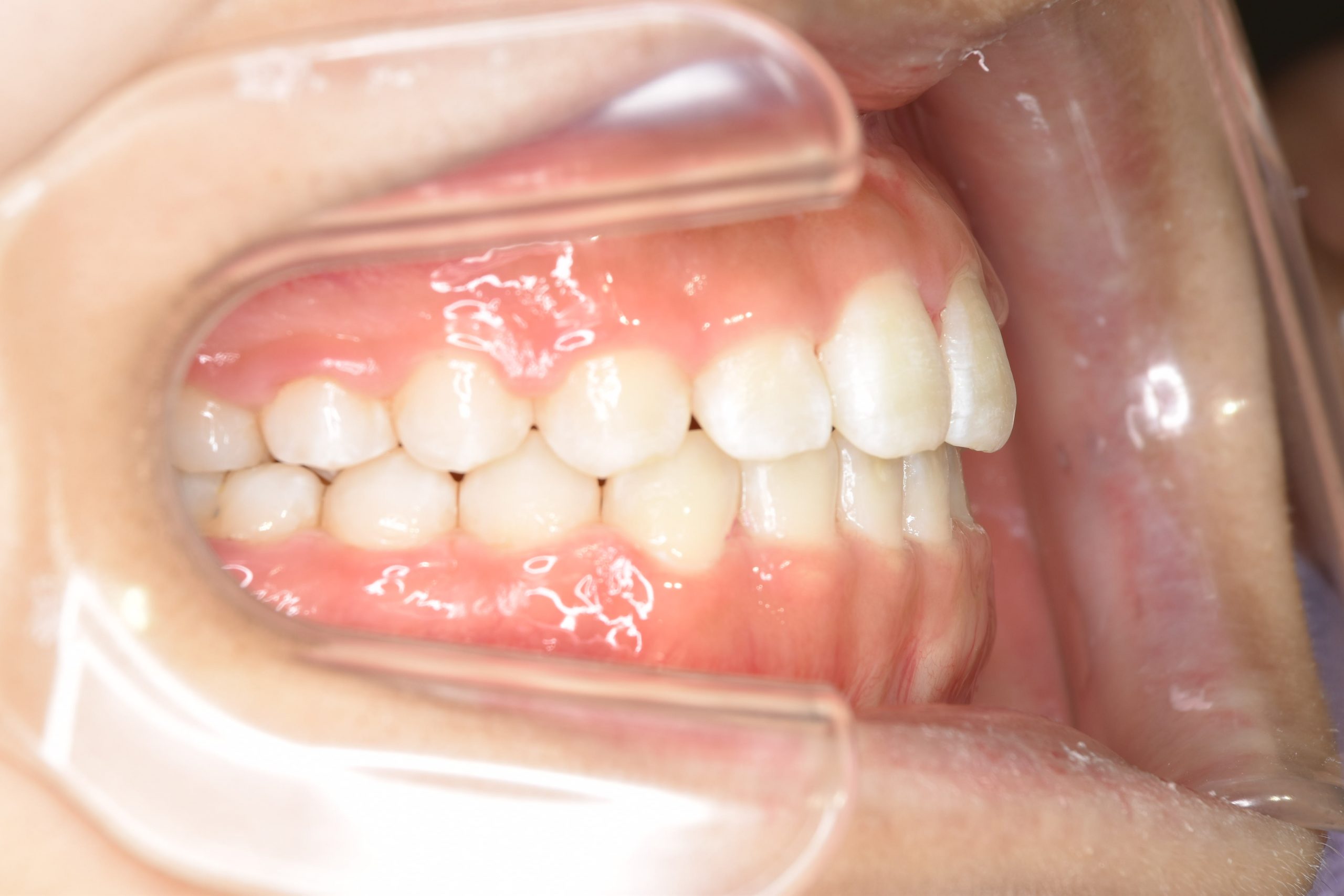 全顎ワイヤー矯正　症例_148