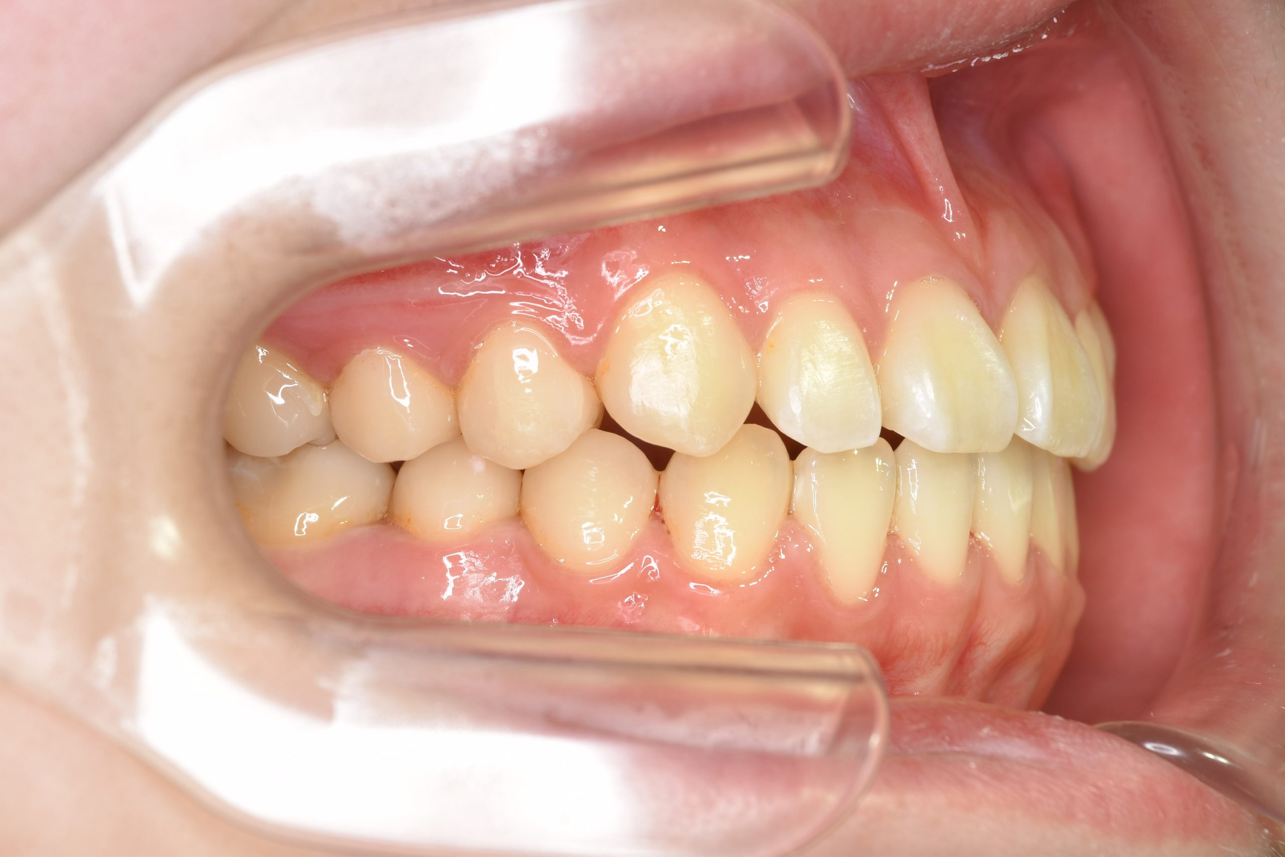 全顎ワイヤー矯正　症例_154