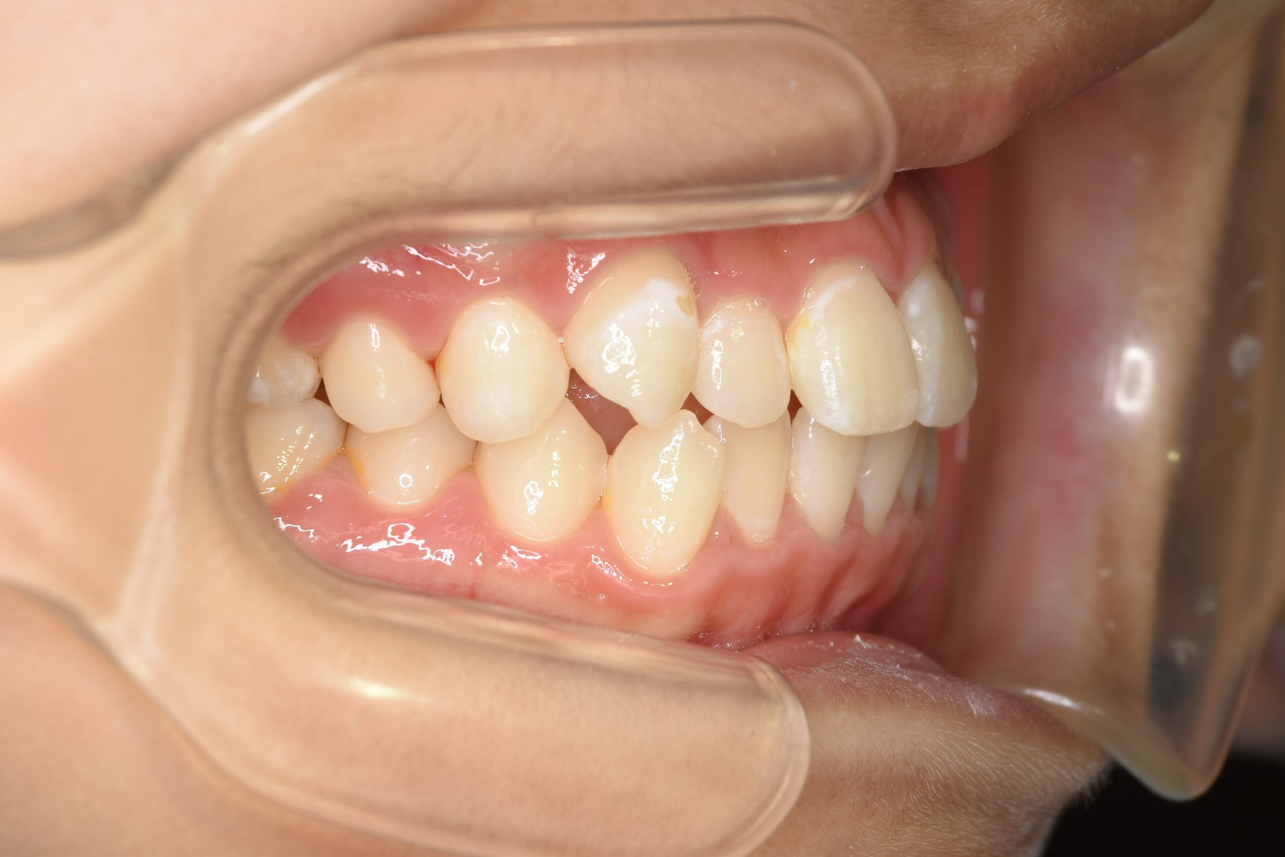 全顎ワイヤー矯正　症例_169