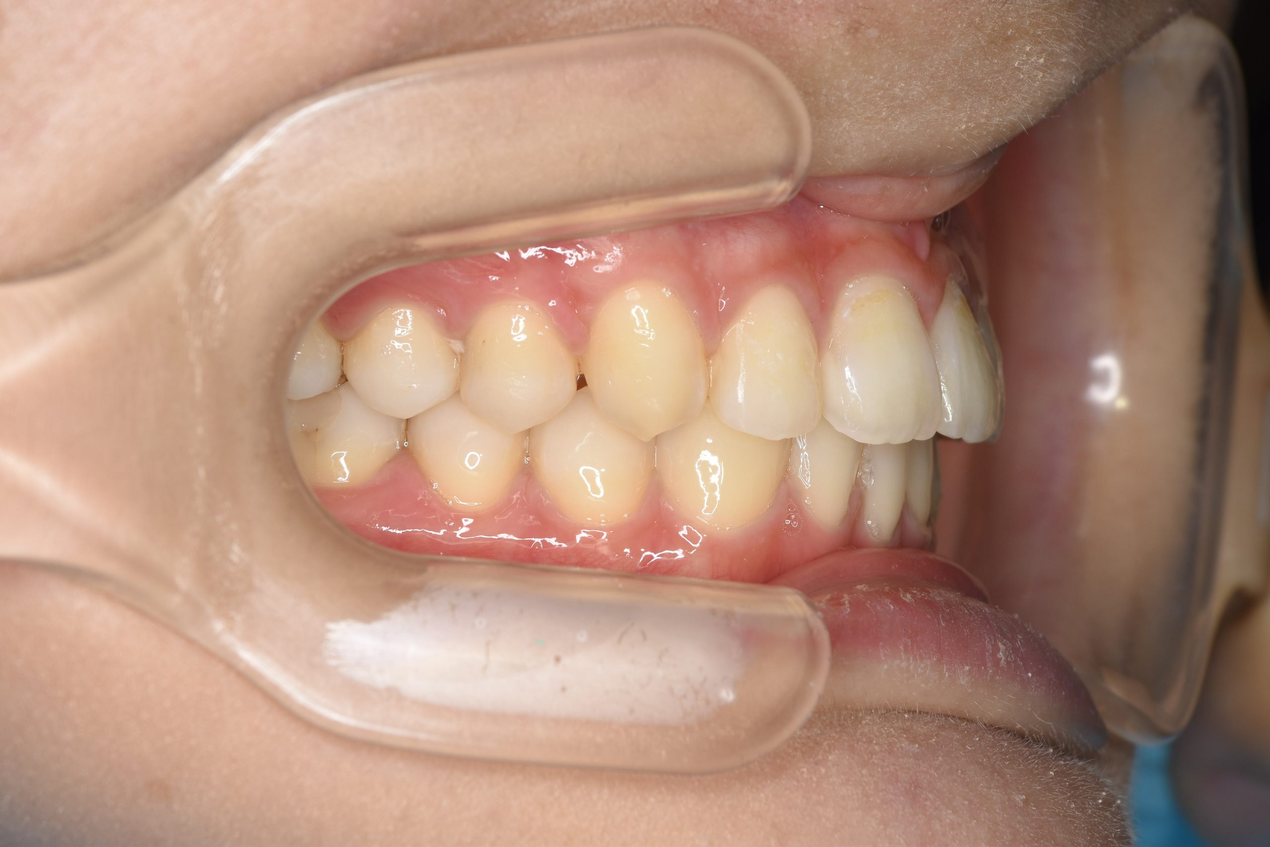 全顎ワイヤー矯正　症例_182