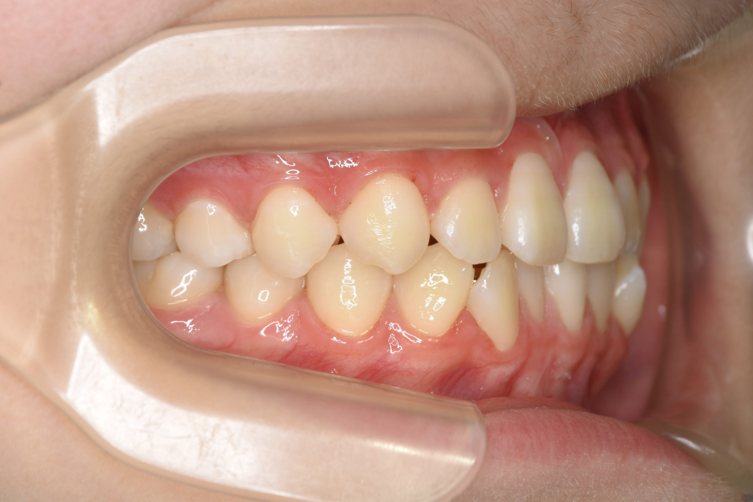 全顎ワイヤー矯正　症例_68